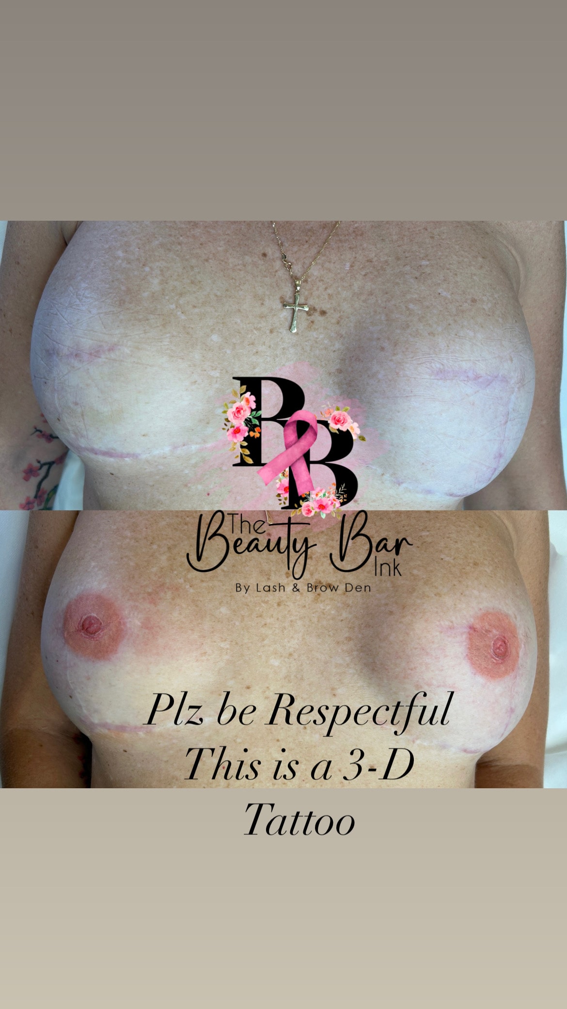 Post mastectomy 3-D areola tattoo before and after