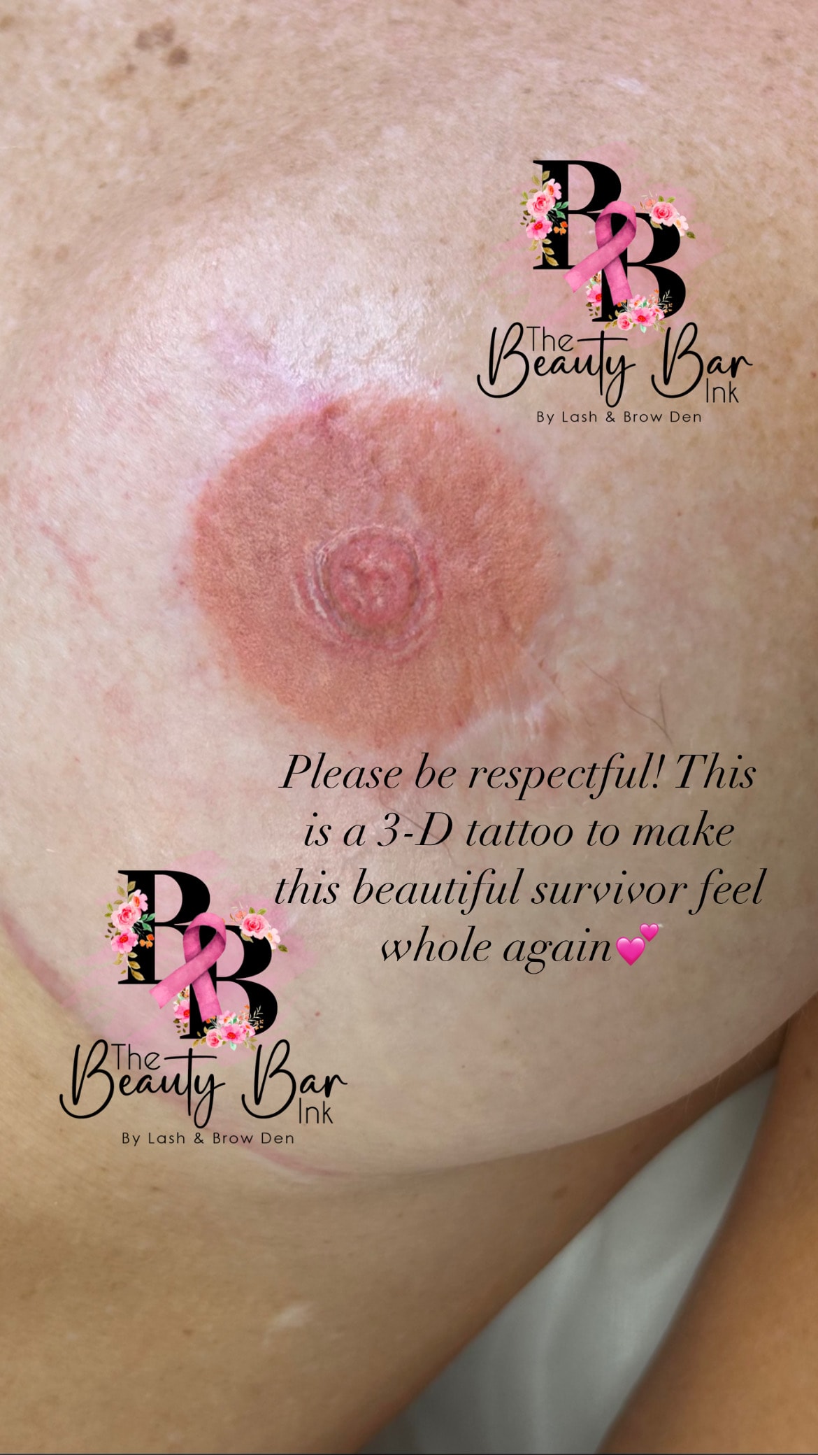 3-D areola tattoo for a beautiful breast cancer survivor