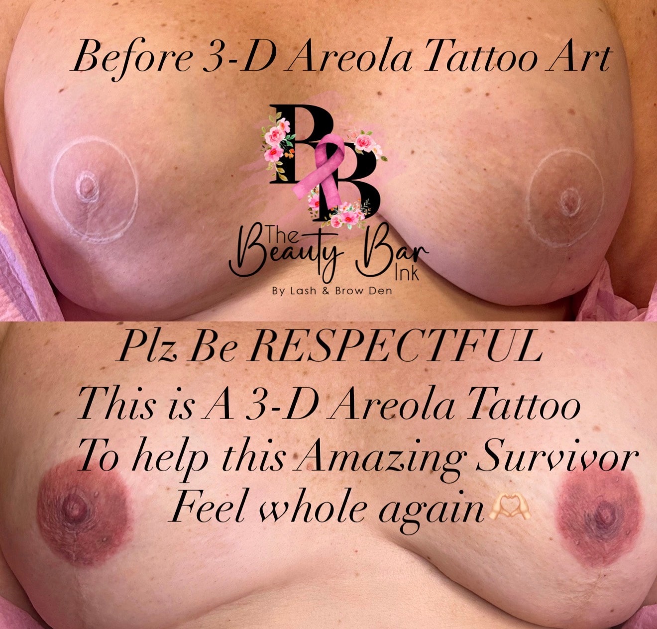 Before 3-D areola tattoo art bilateral result