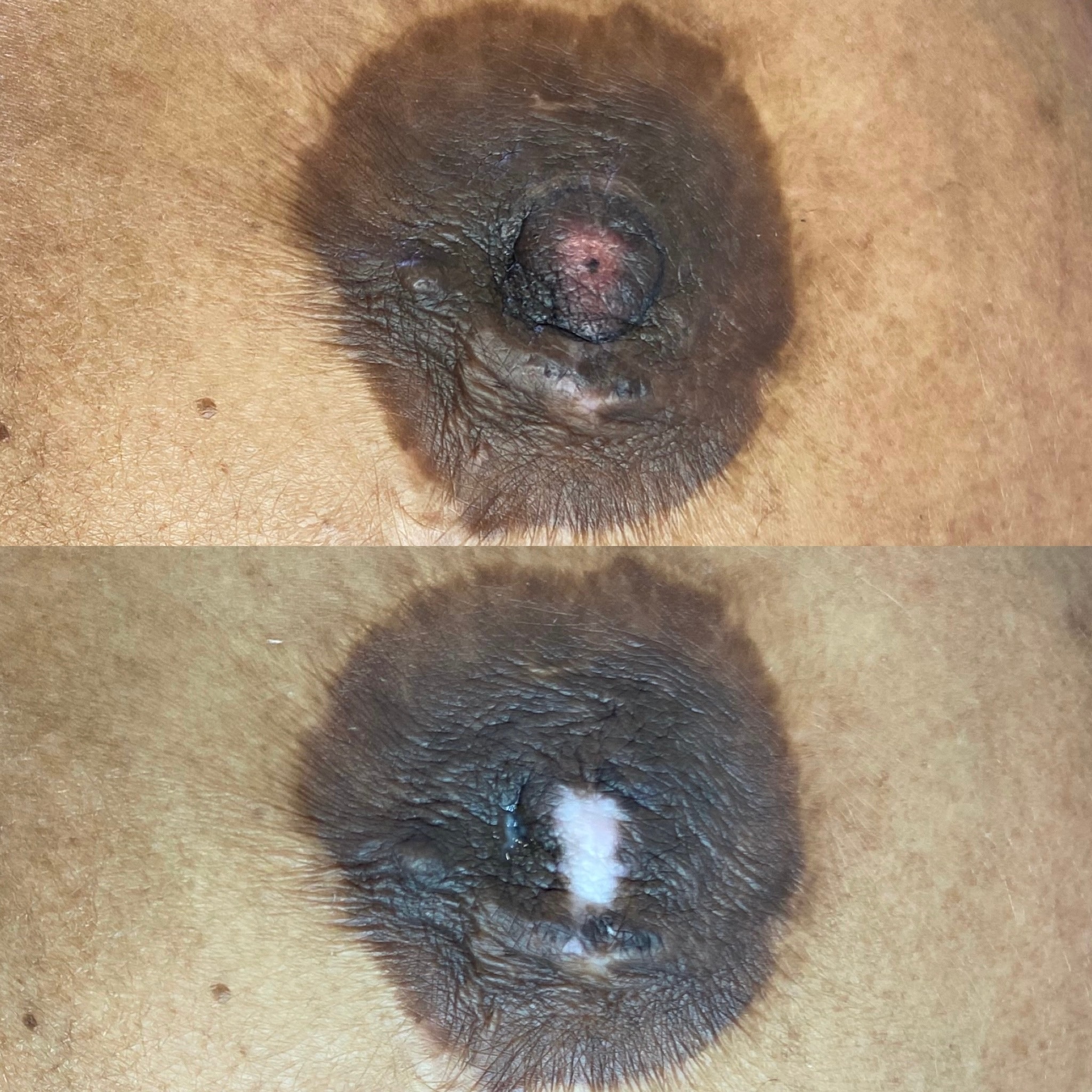 Before and after bilateral areola restoration