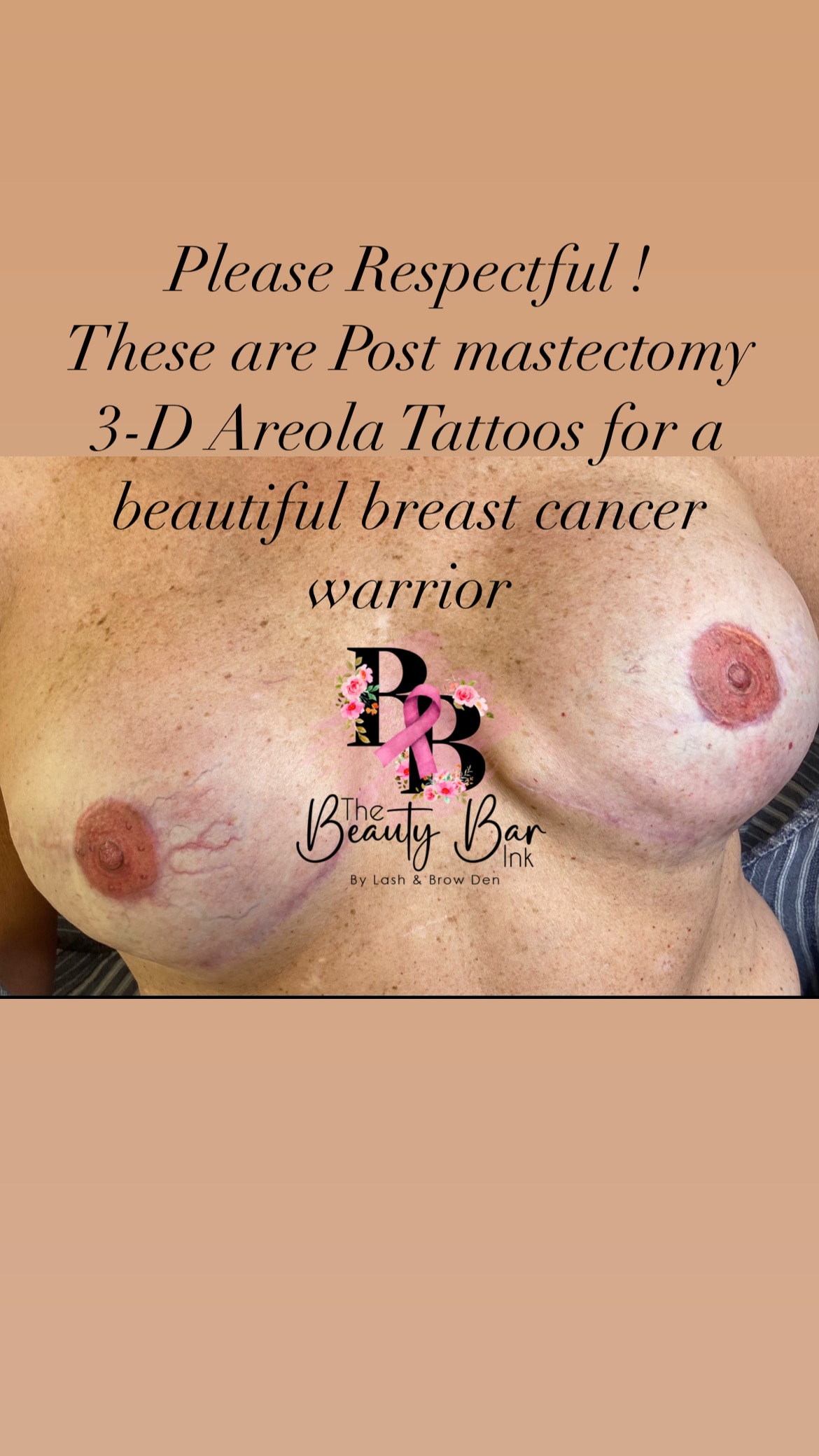 Before and after bilateral areola restoration second client