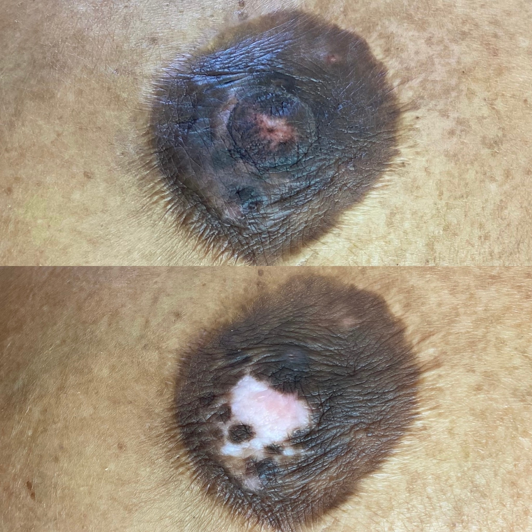 Close up before and after areola restoration