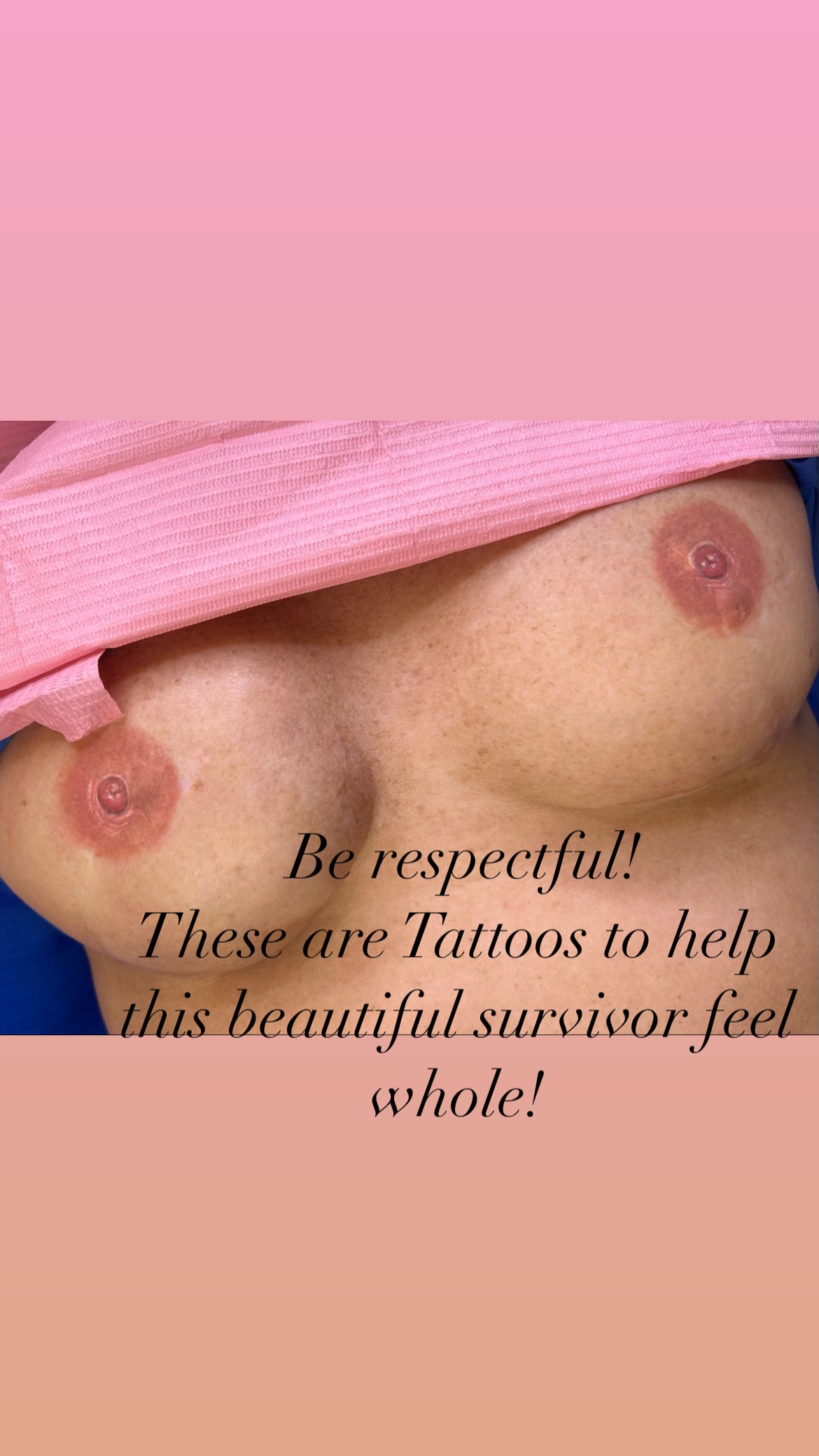 Close up before and after areola restoration second client