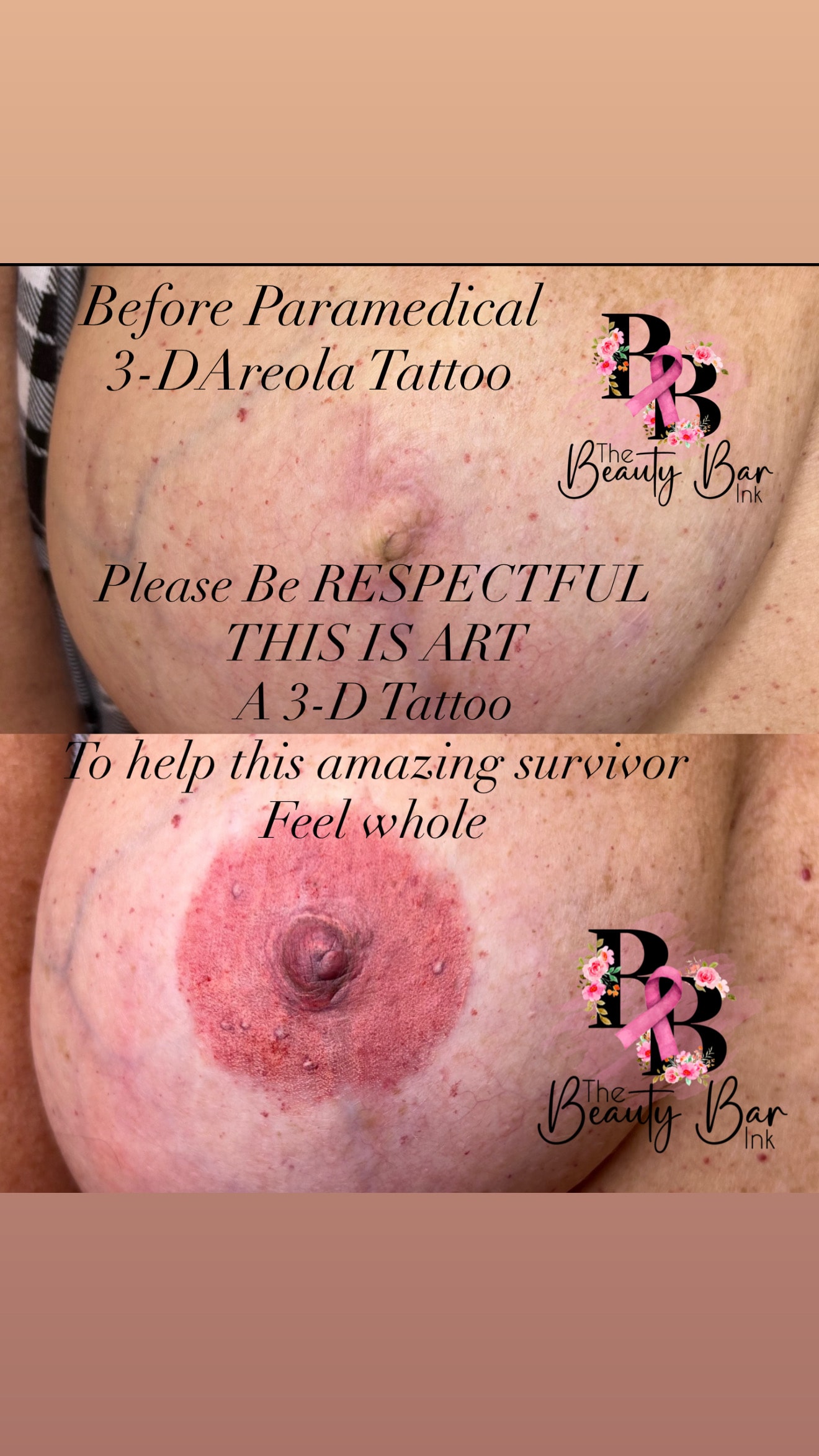 Before and after paramedical 3-D areola tattoo to help survivor feel whole