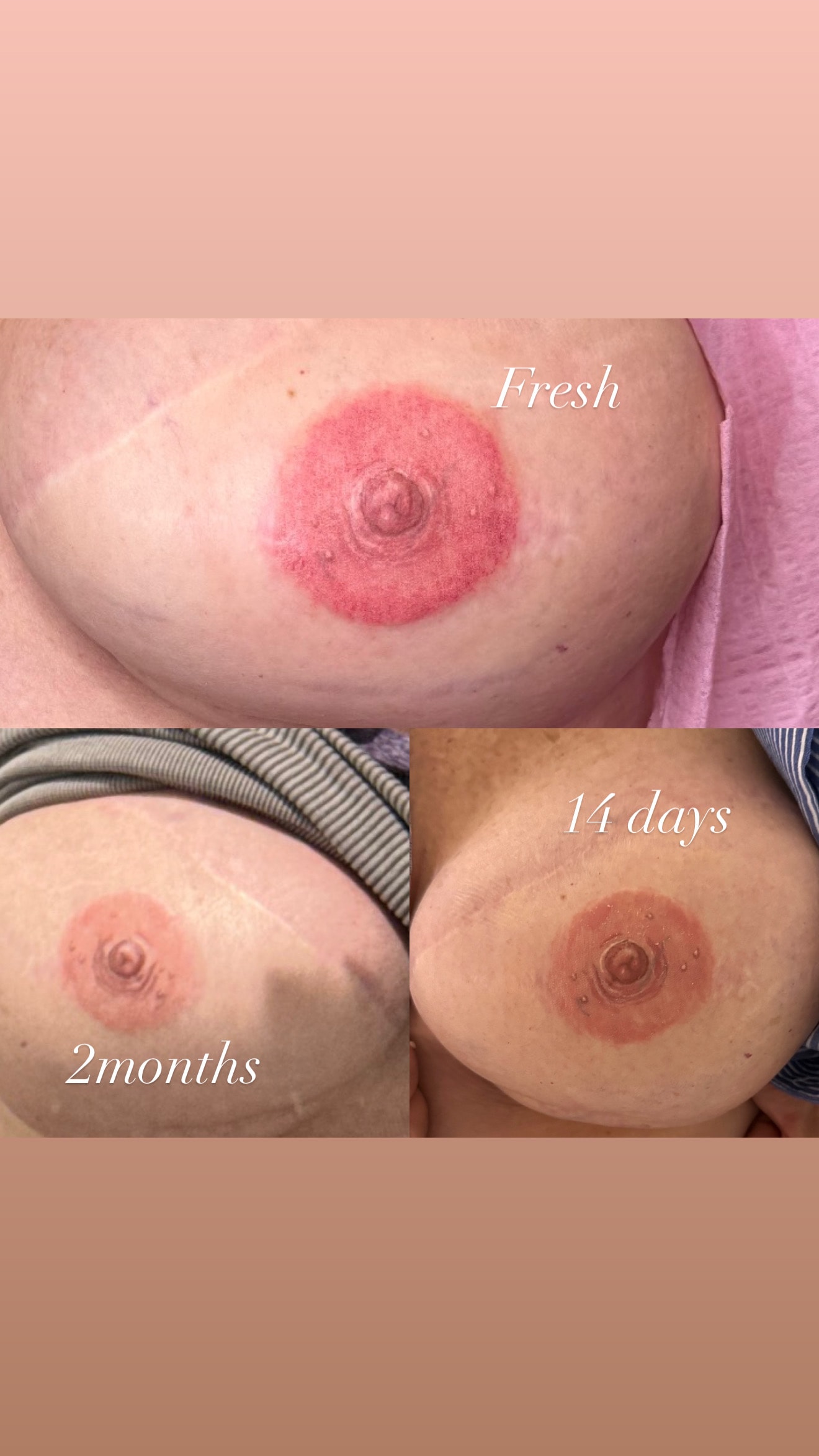 3-D areola tattoo healing progression showing fresh, 14 days, and 2 months results