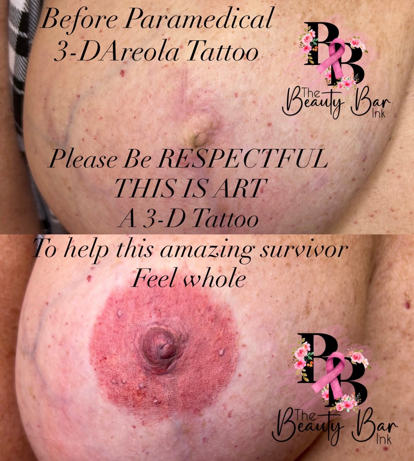 Before and after paramedical 3-D areola tattoo to help survivor feel whole