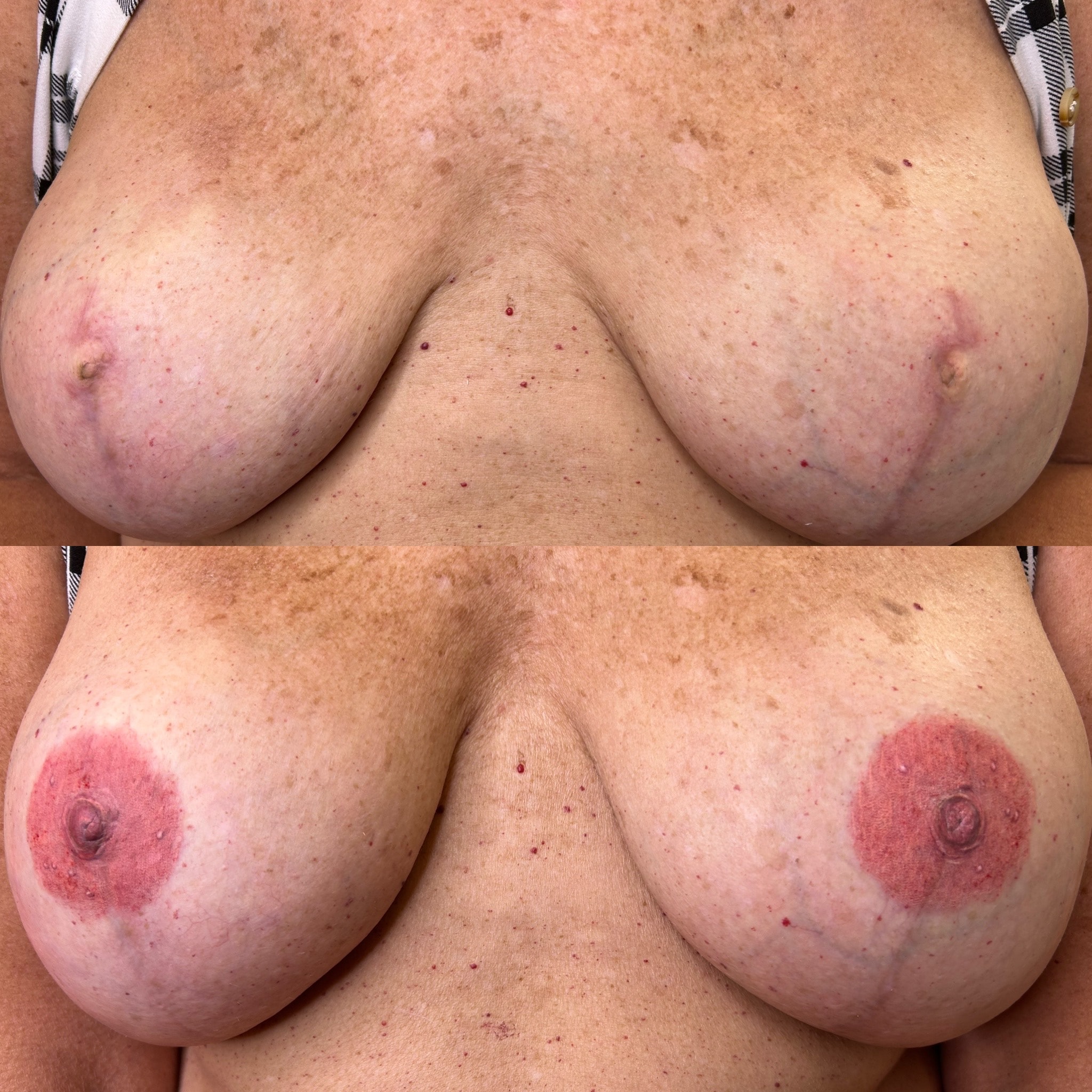 3-D areola tattoos helping a survivor feel whole