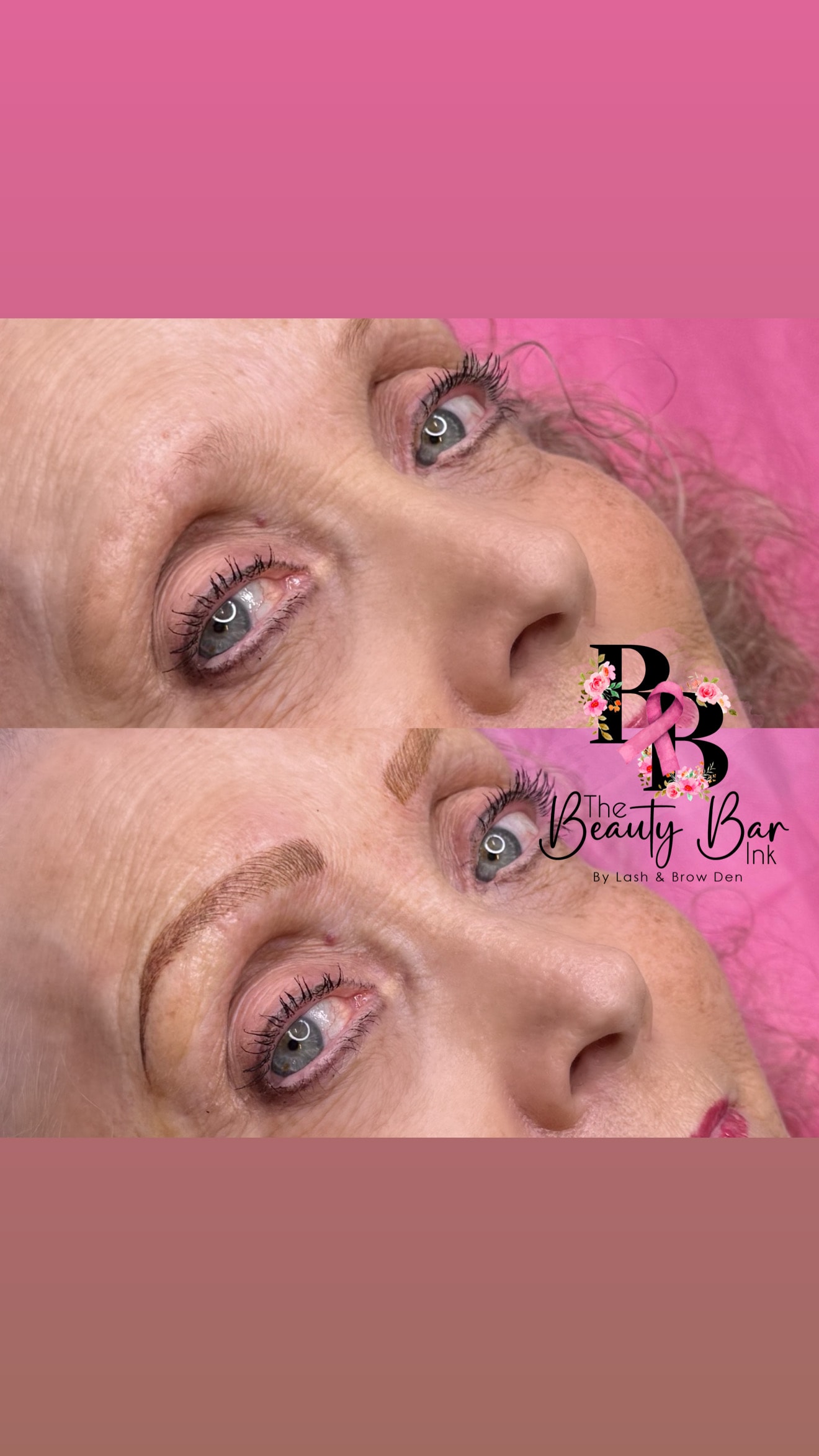 Brow correction before and after comparison