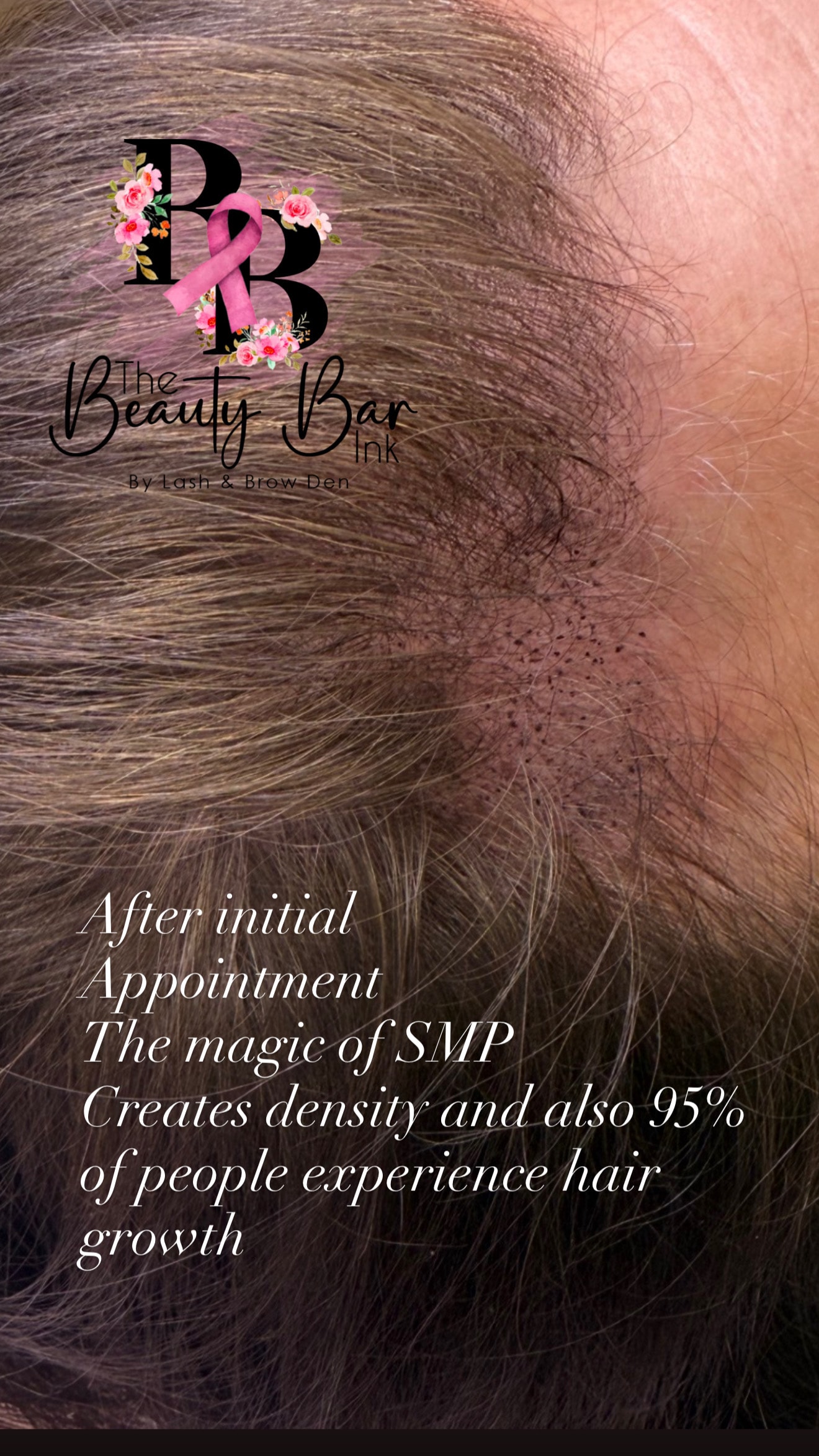 After initial SMP appointment showing density and hair growth