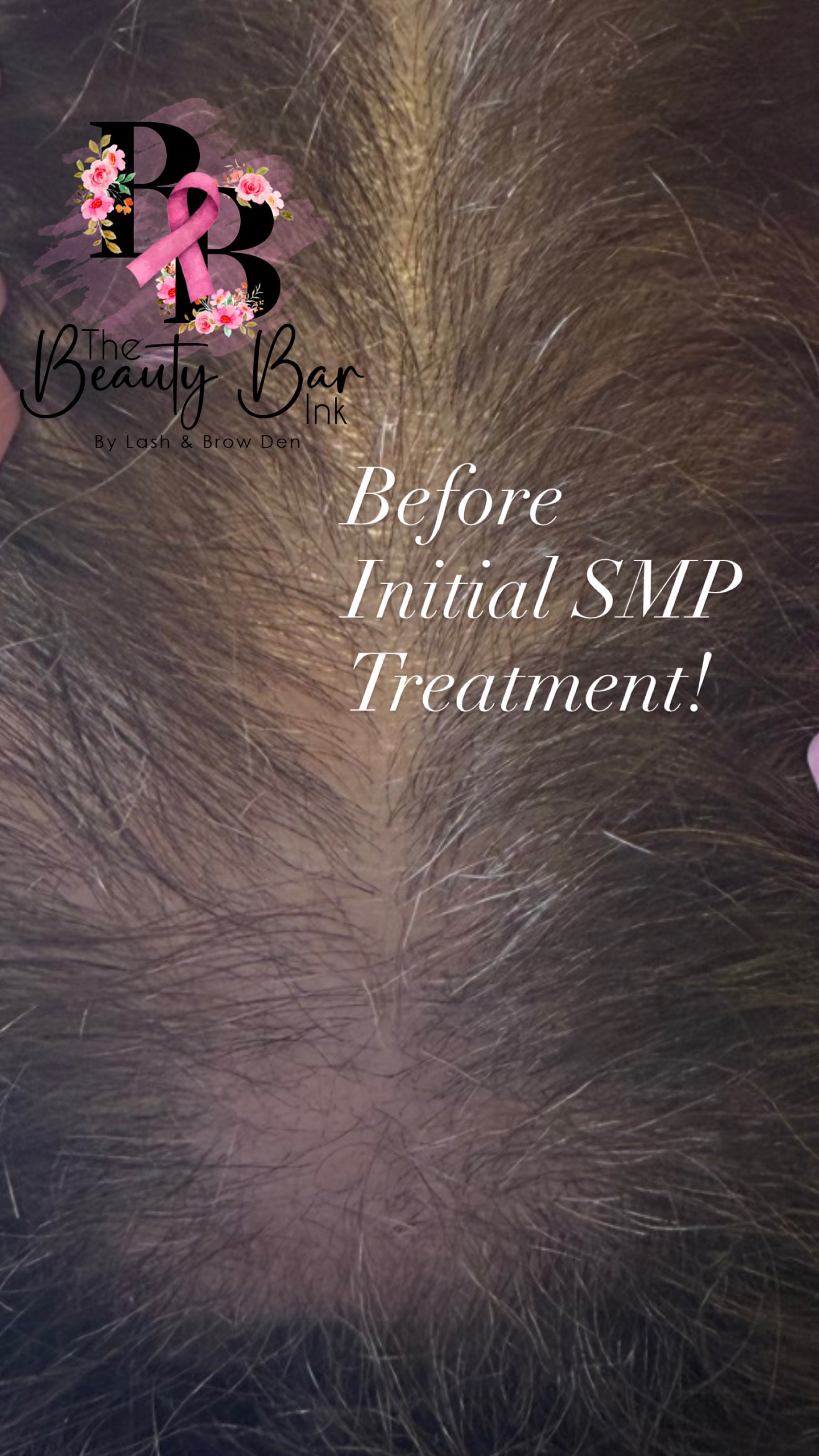 Before initial scalp micropigmentation treatment