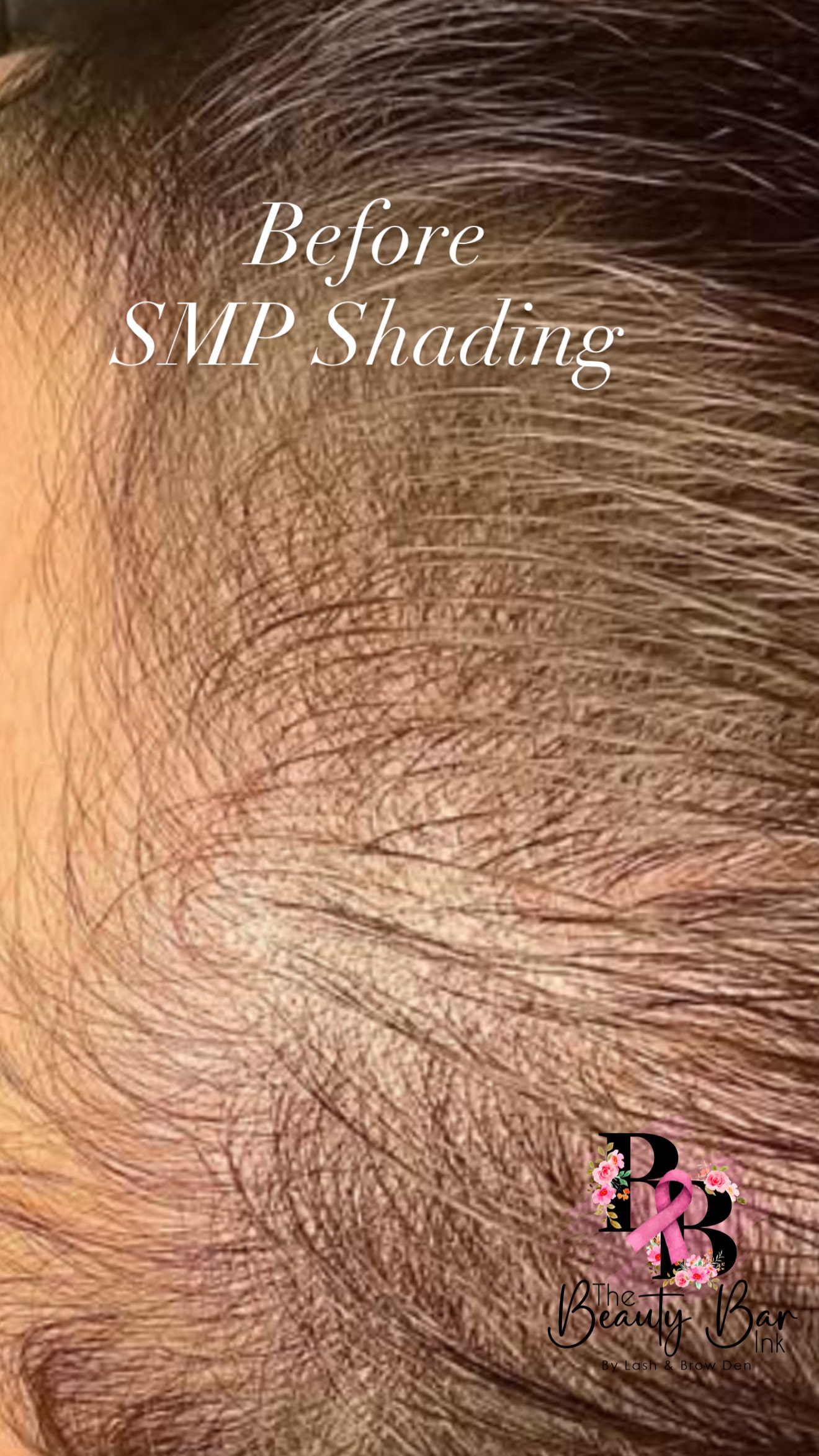 Before SMP shading treatment on thinning hairline