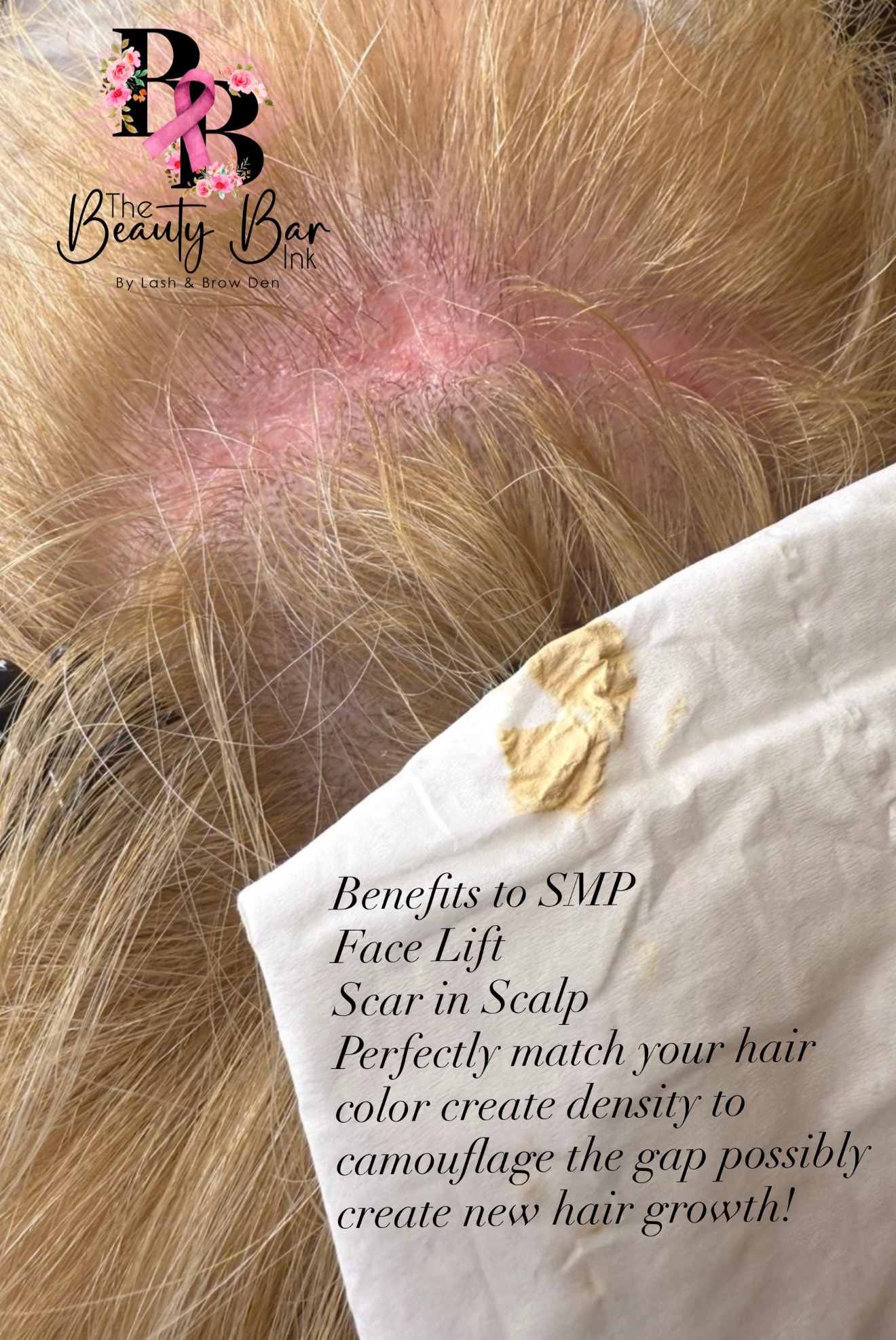 Benefits of SMP for face lift scar in scalp creating density