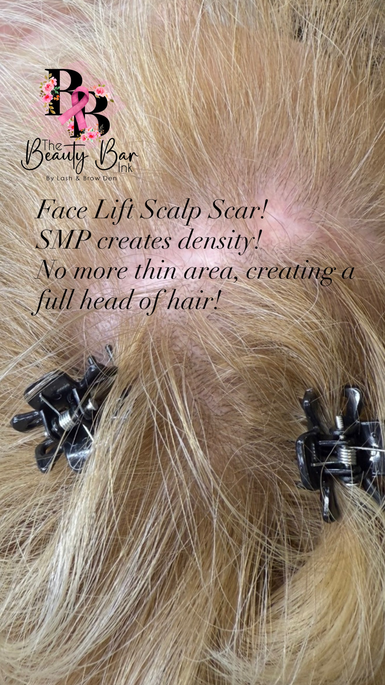 Face lift scalp scar treated with SMP to create a full head of hair
