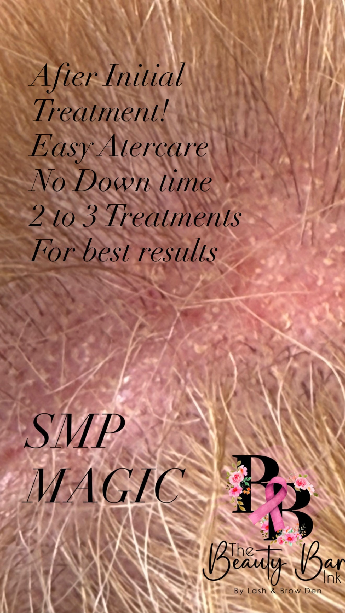 SMP magic after initial treatment easy aftercare no downtime