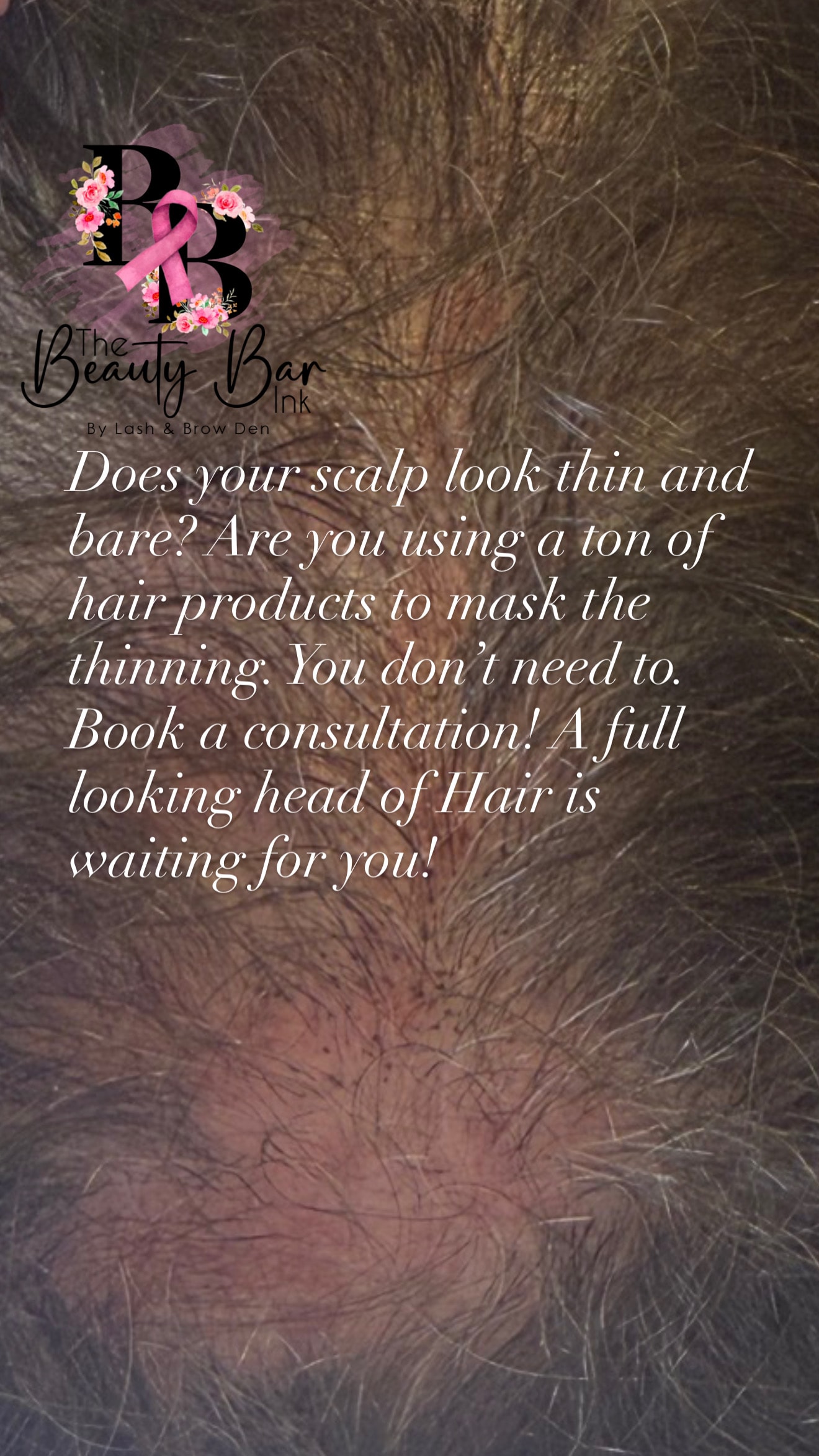 Thin and bare scalp before SMP treatment book a consultation