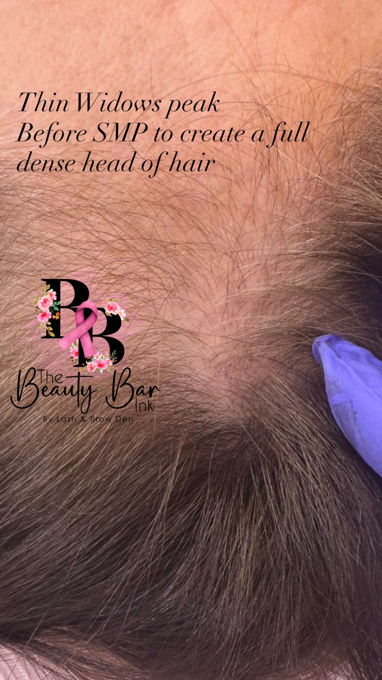 Thin widows peak before SMP to create a full dense head of hair