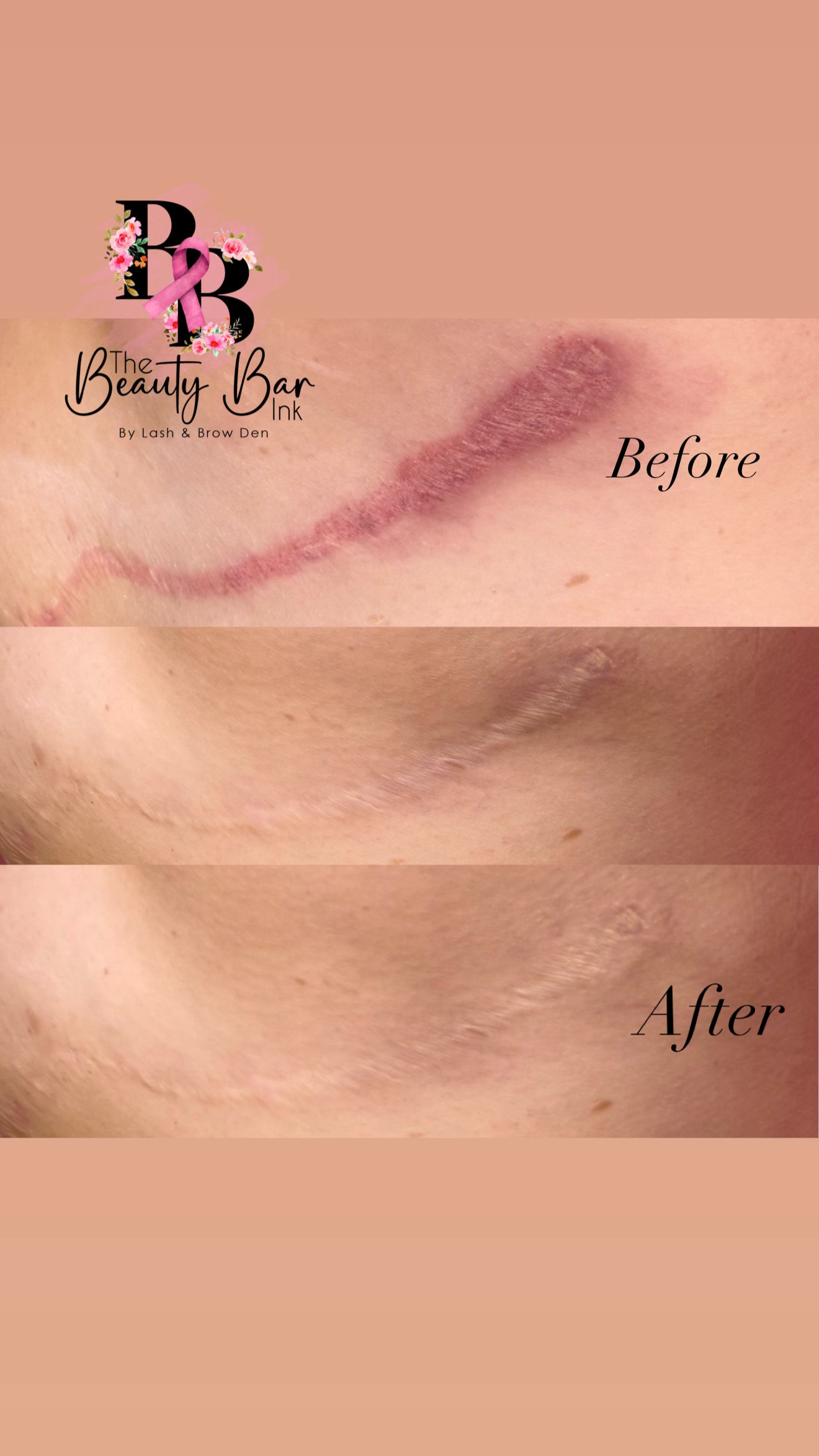 Before and after 3 panel scar restoration showing dramatic improvement