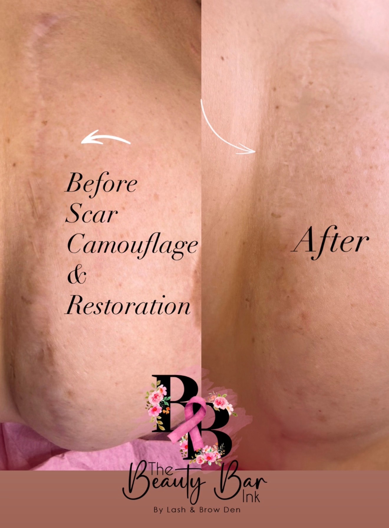Before and after scar camouflage and restoration side by side comparison