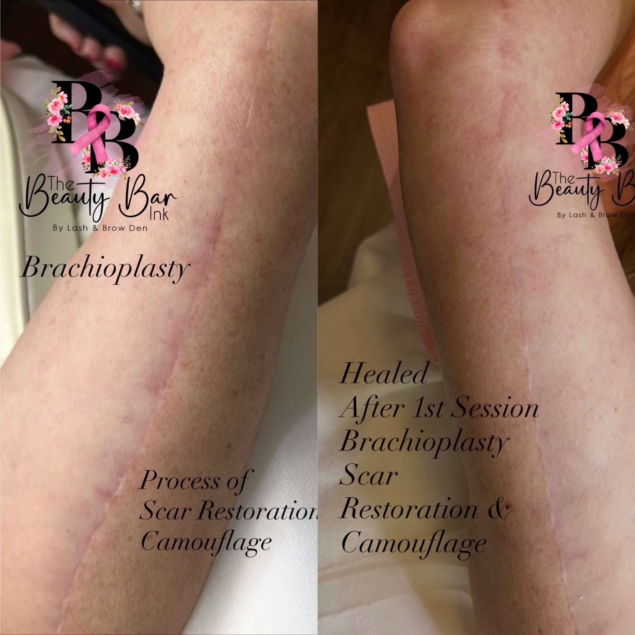 Brachioplasty before and after scar restoration and camouflage split view