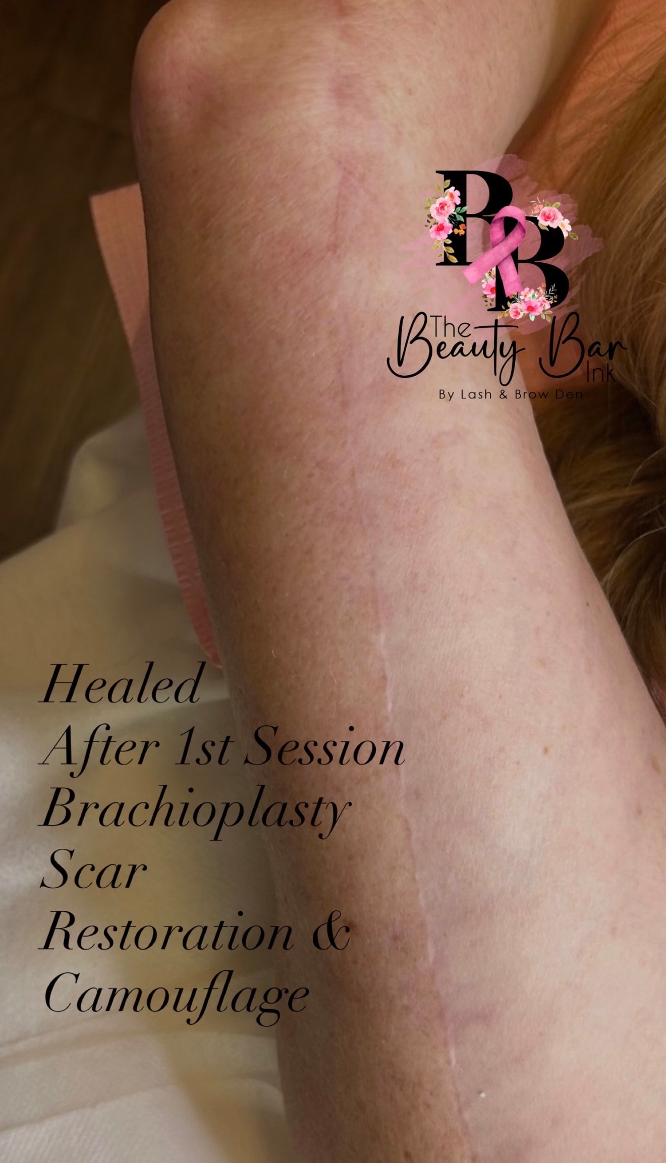 Brachioplasty scar healed after 1st session scar restoration and camouflage