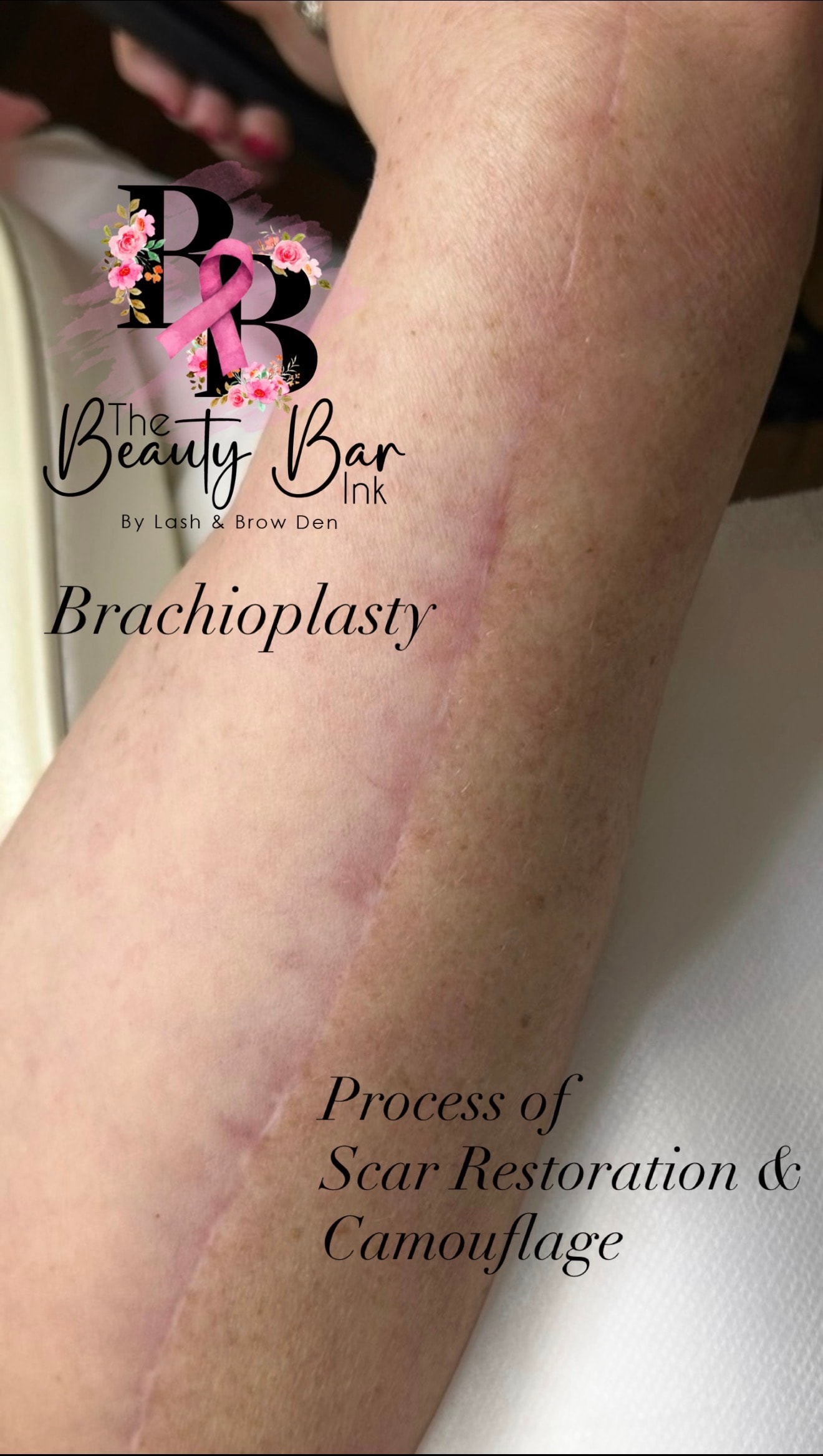 Brachioplasty process of scar restoration and camouflage close up