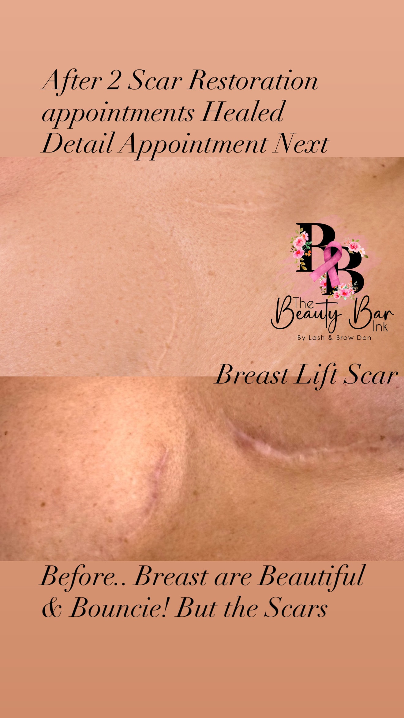 Breast lift scar before and after 2 scar restoration appointments healed