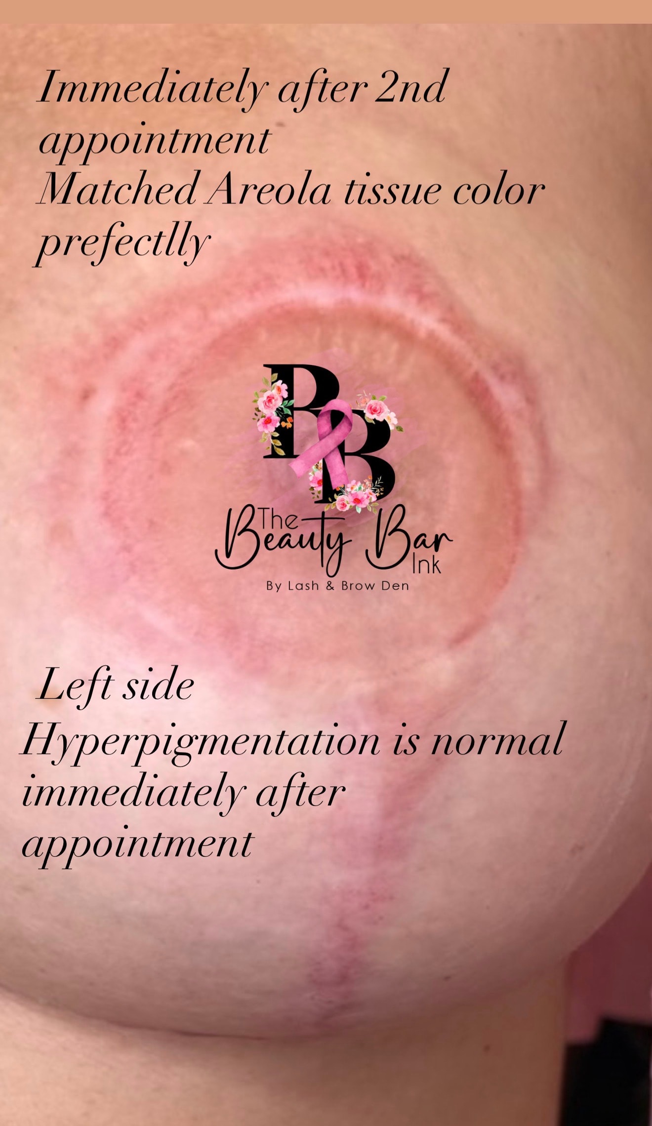 Immediately after 2nd appointment matched areola tissue color perfectly left side hyperpigmentation is normal
