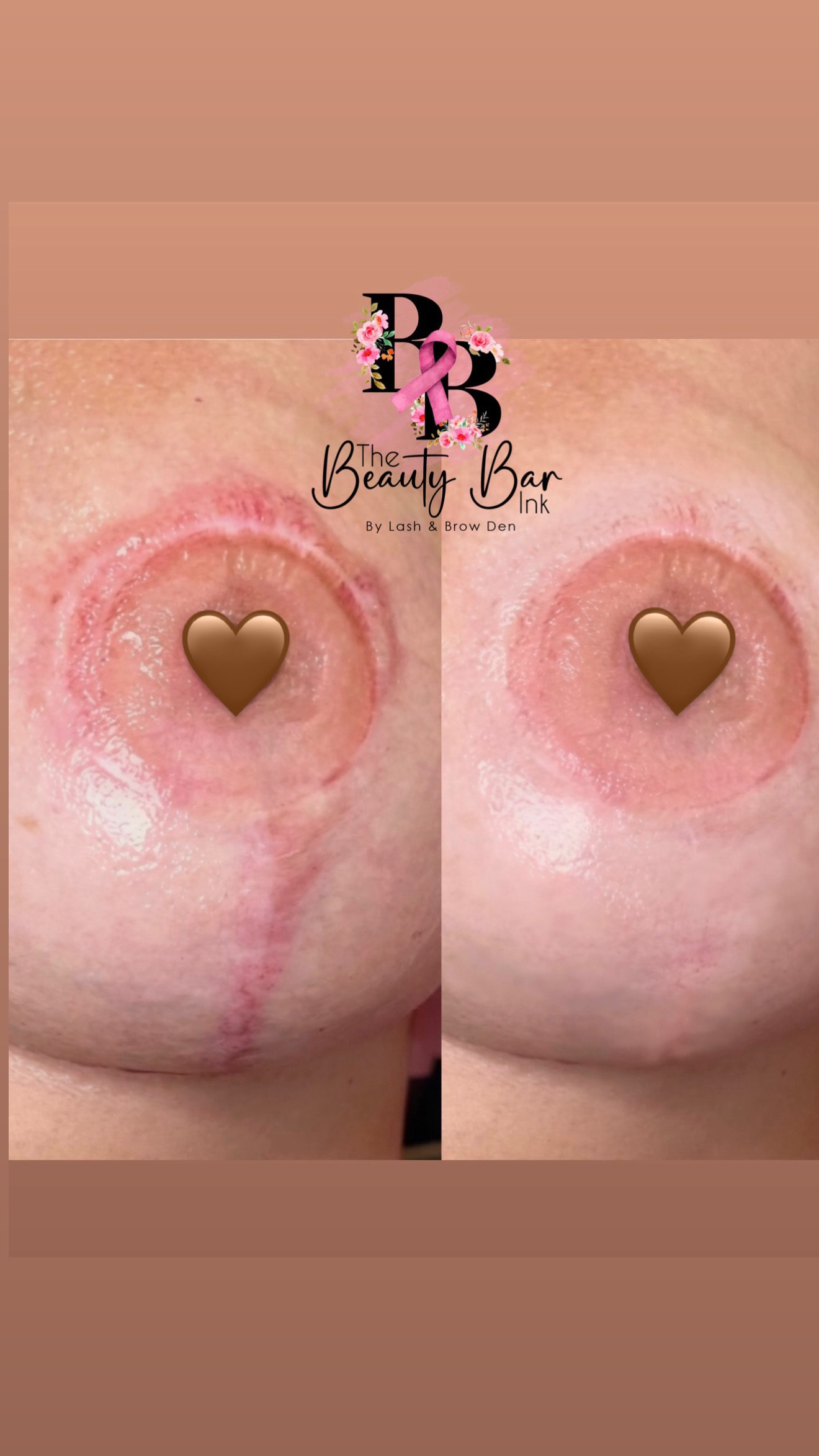 Breast scar before and after split view scar camouflage restoration