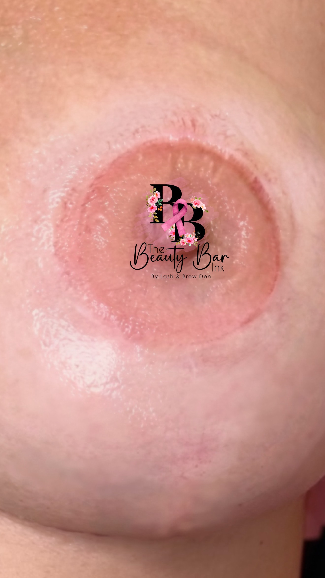 Breast scar fresh close up after scar camouflage treatment