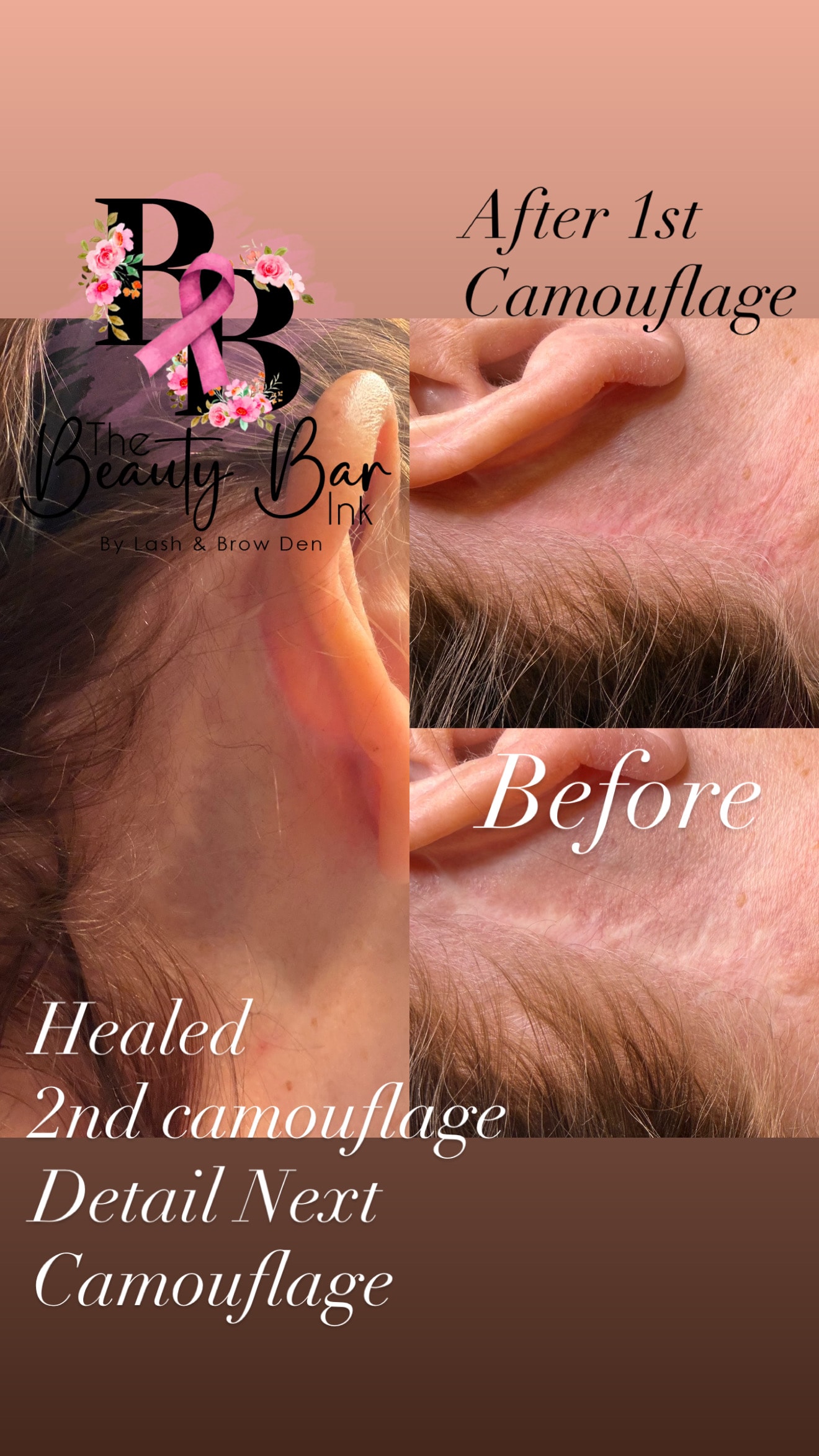 Ear face lift scar healed after 2nd camouflage treatment detail next session