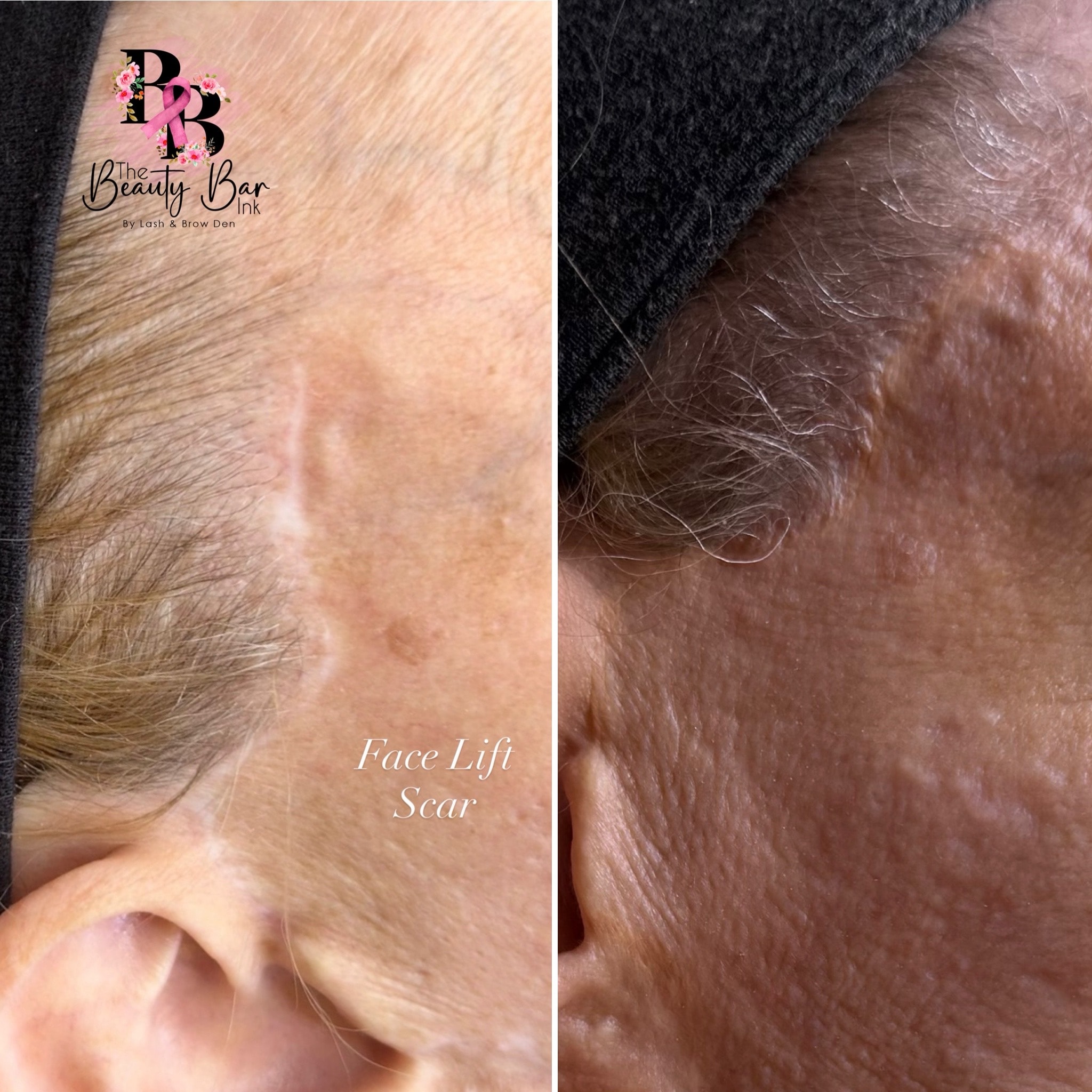 Face lift scar before and after split view scar camouflage treatment