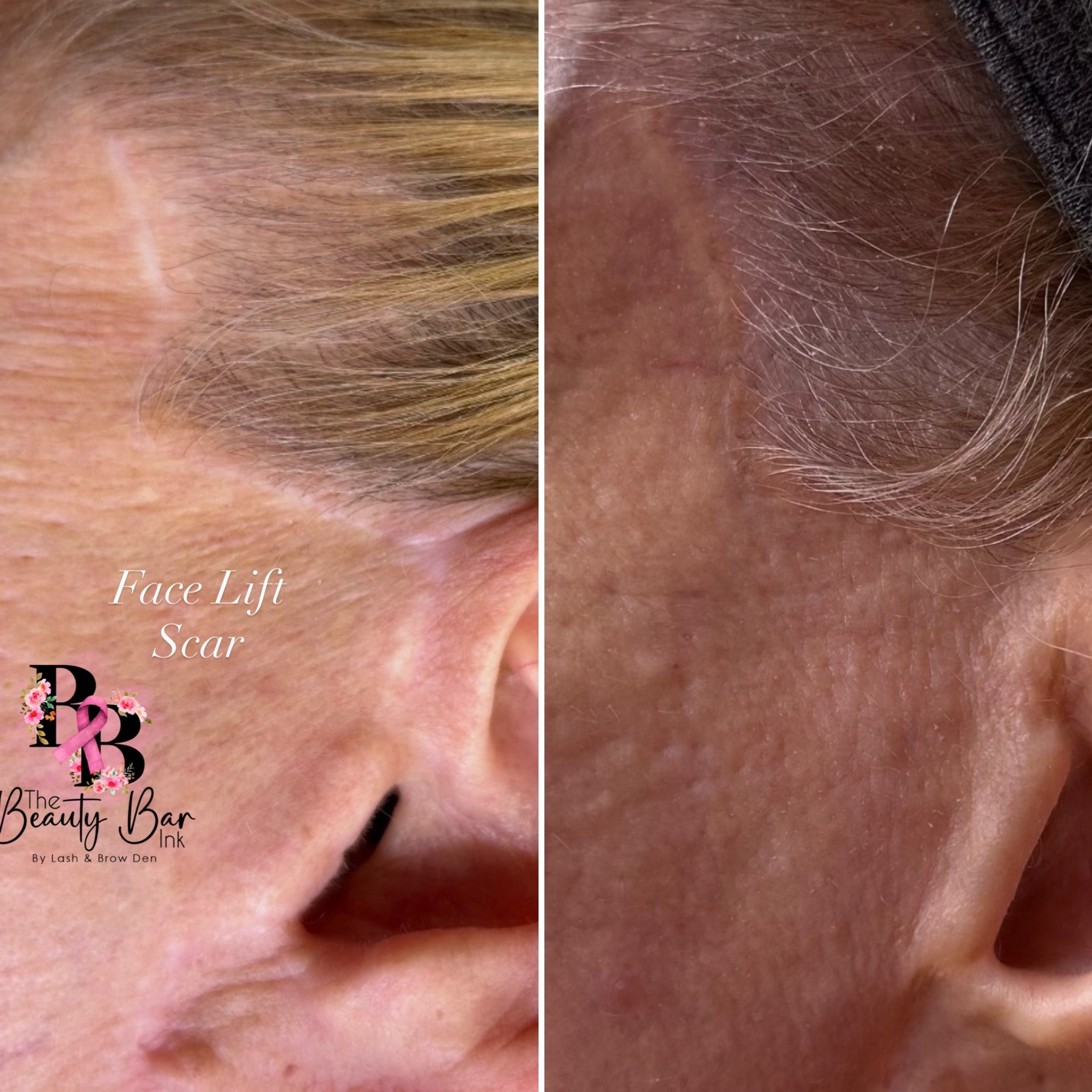 Face lift scar before and after split view scar camouflage third client