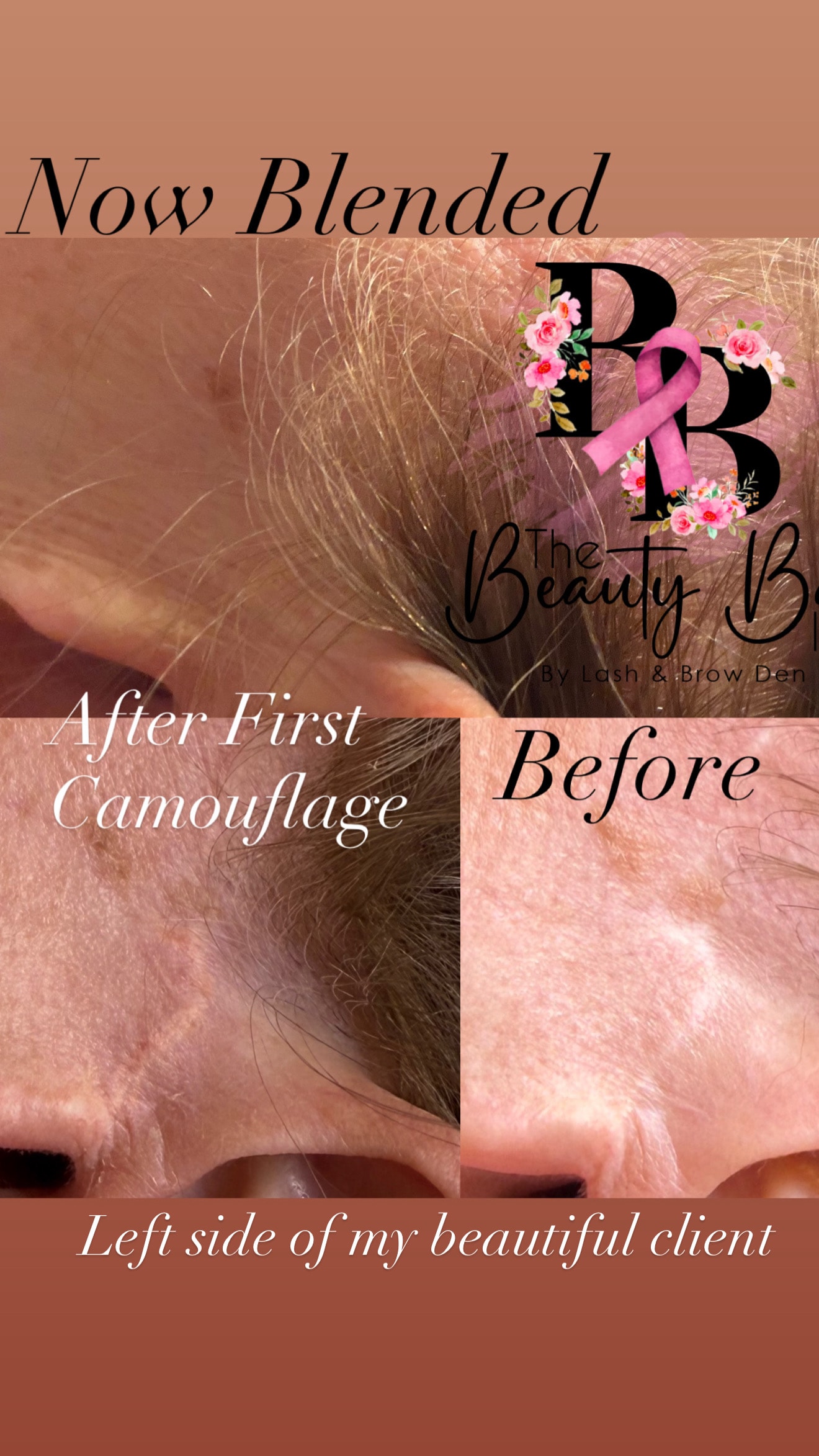 Face lift scar now blended after first camouflage treatment before and after
