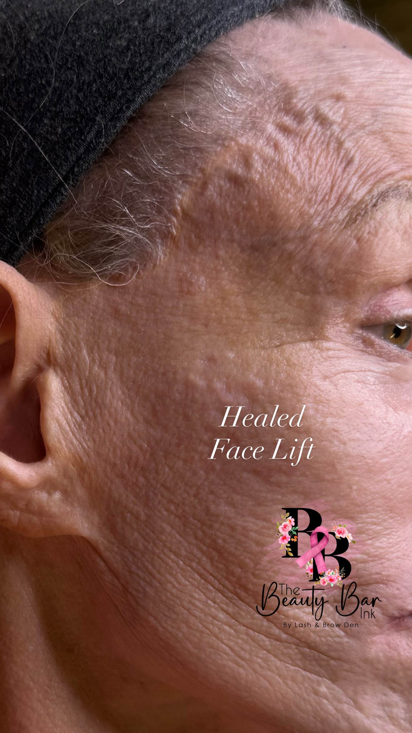 Healed face lift scar camouflage and restoration result close up