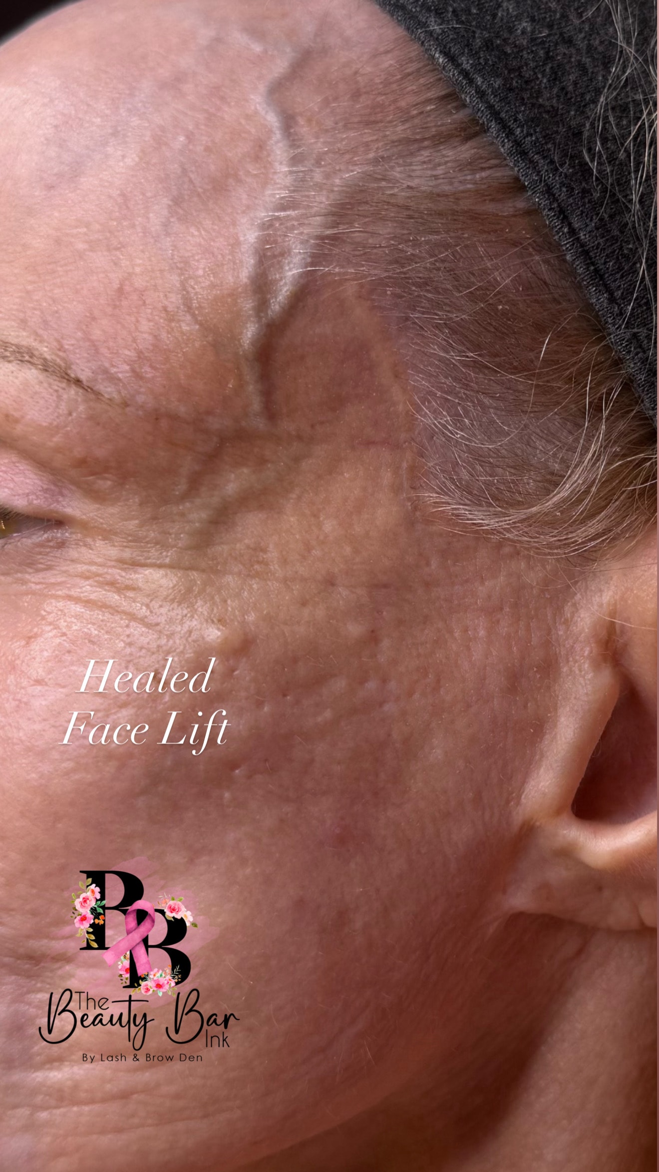 Healed face lift scar portrait result after scar camouflage and restoration