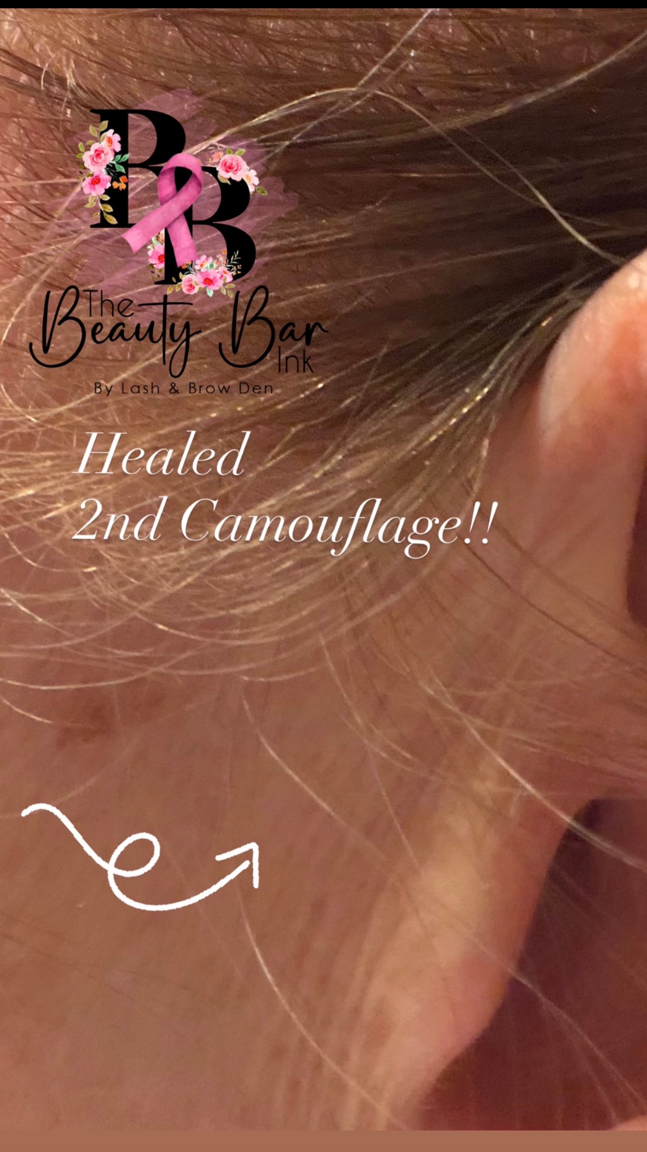 Healed 2nd camouflage appointment ear scar blending beautifully