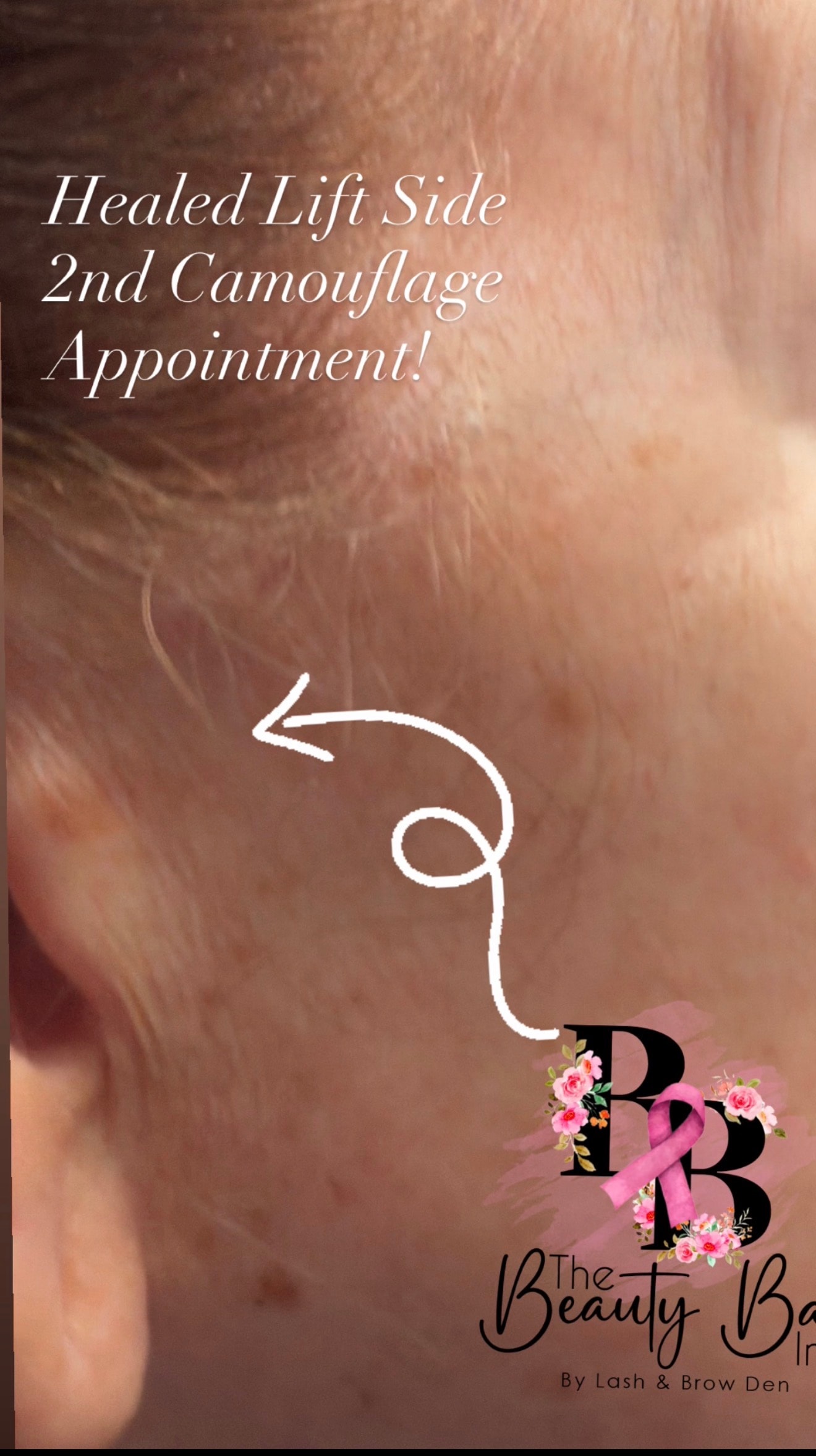 Healed lift side after 2nd scar camouflage appointment