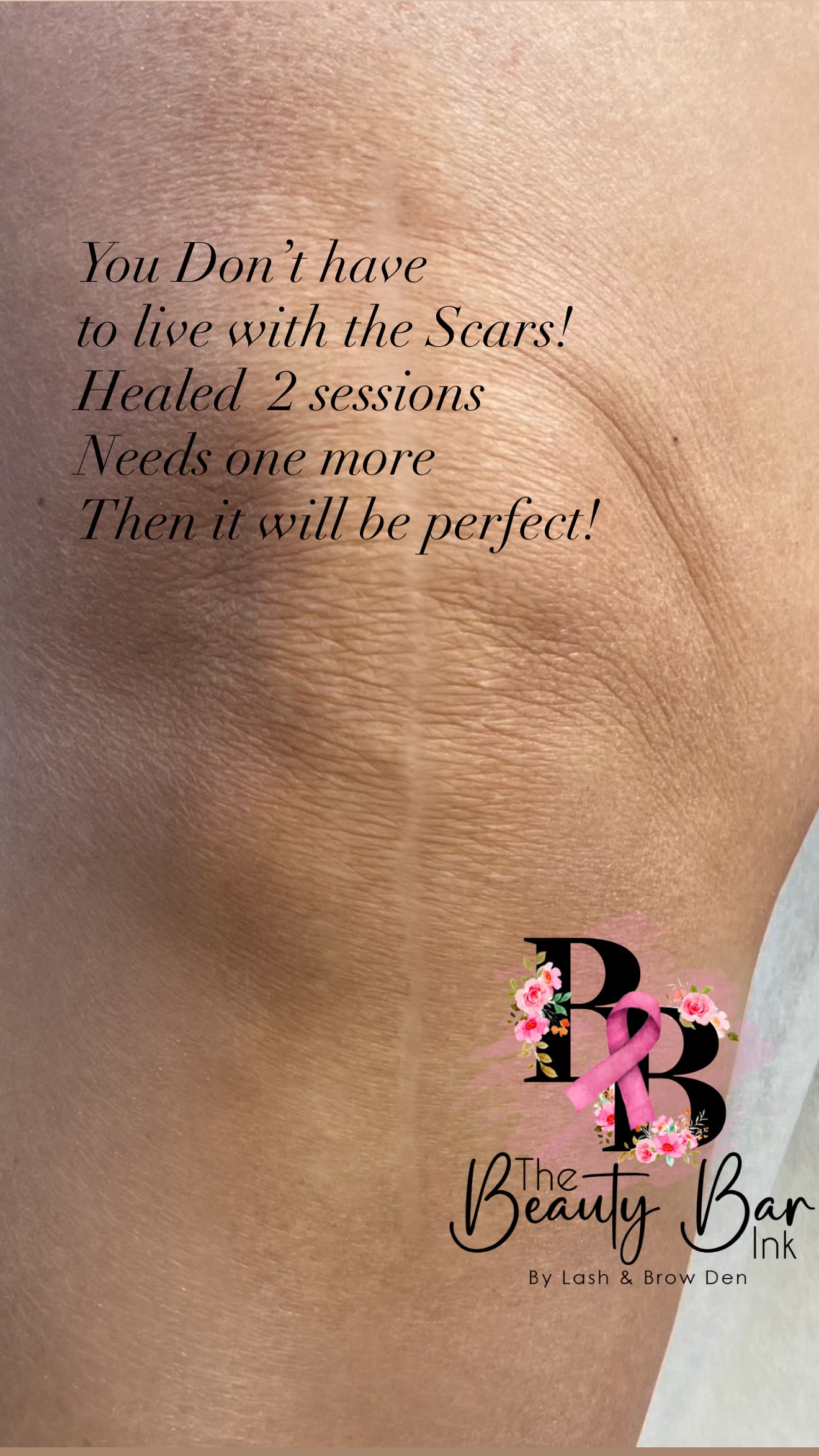 Knee replacement scar healed after 2 sessions needs one more then perfect