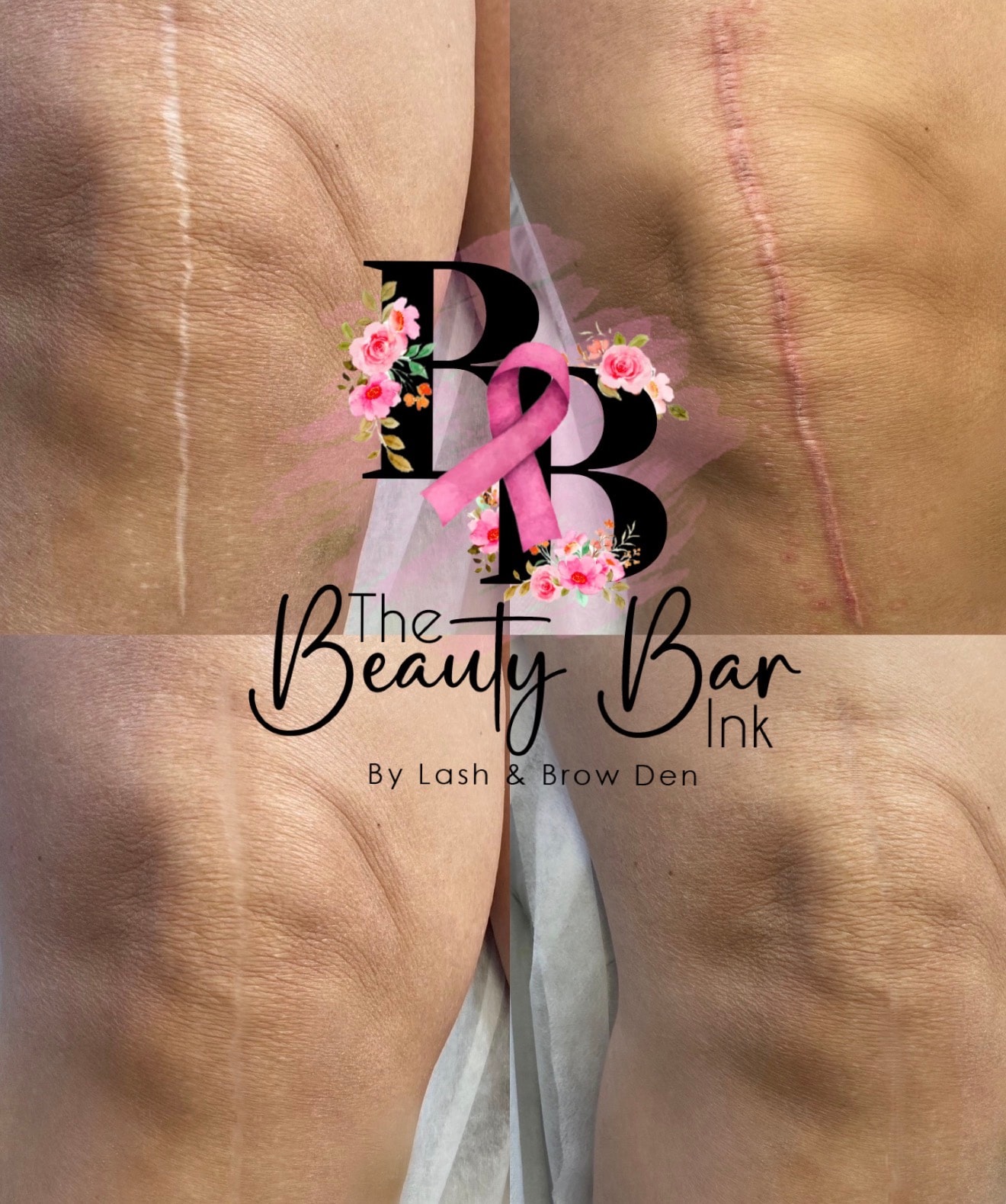 Knee replacement scar restoration and camouflage before and after
