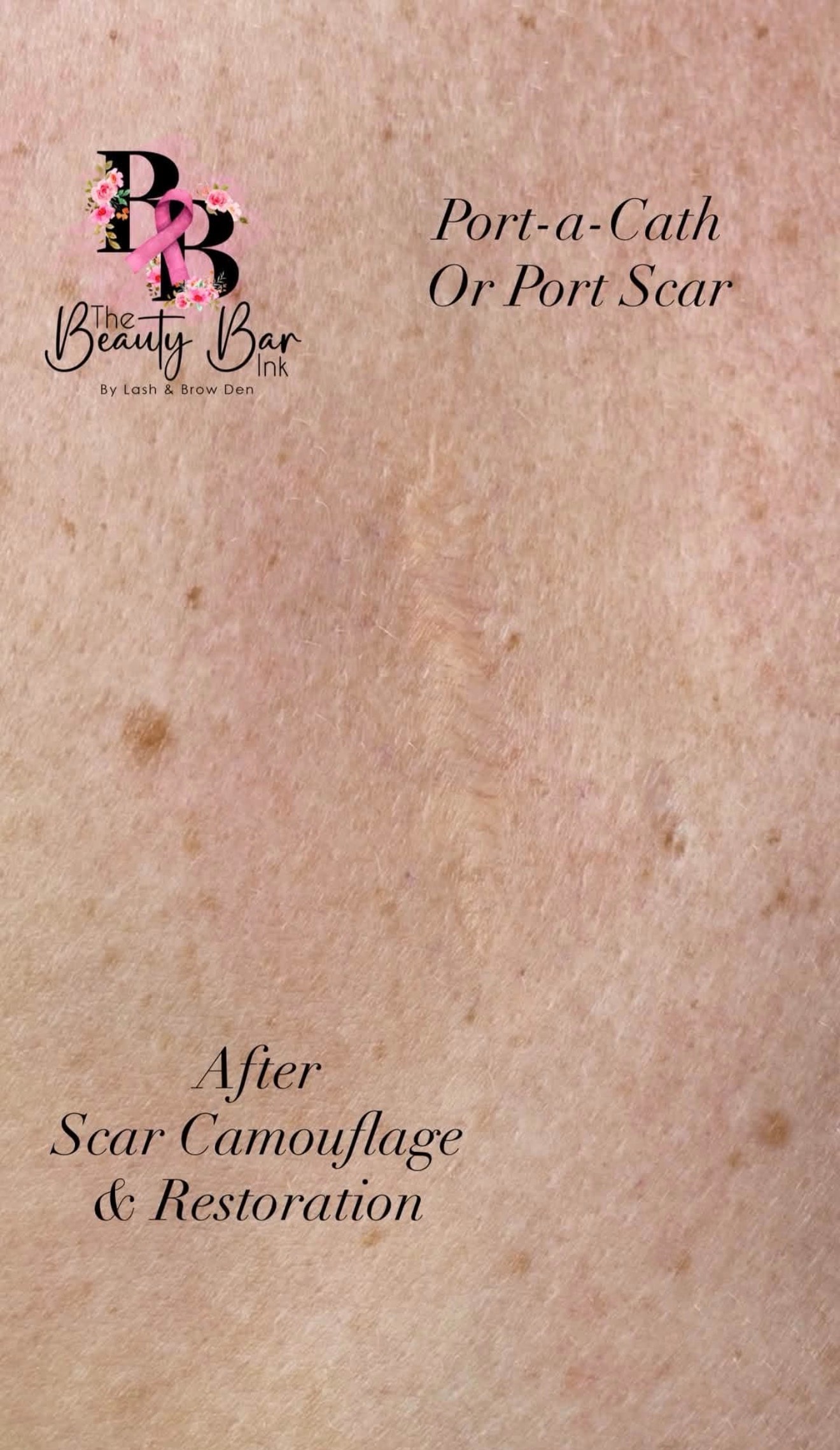 Port-a-Cath or port scar after scar camouflage and restoration treatment beautifully blended