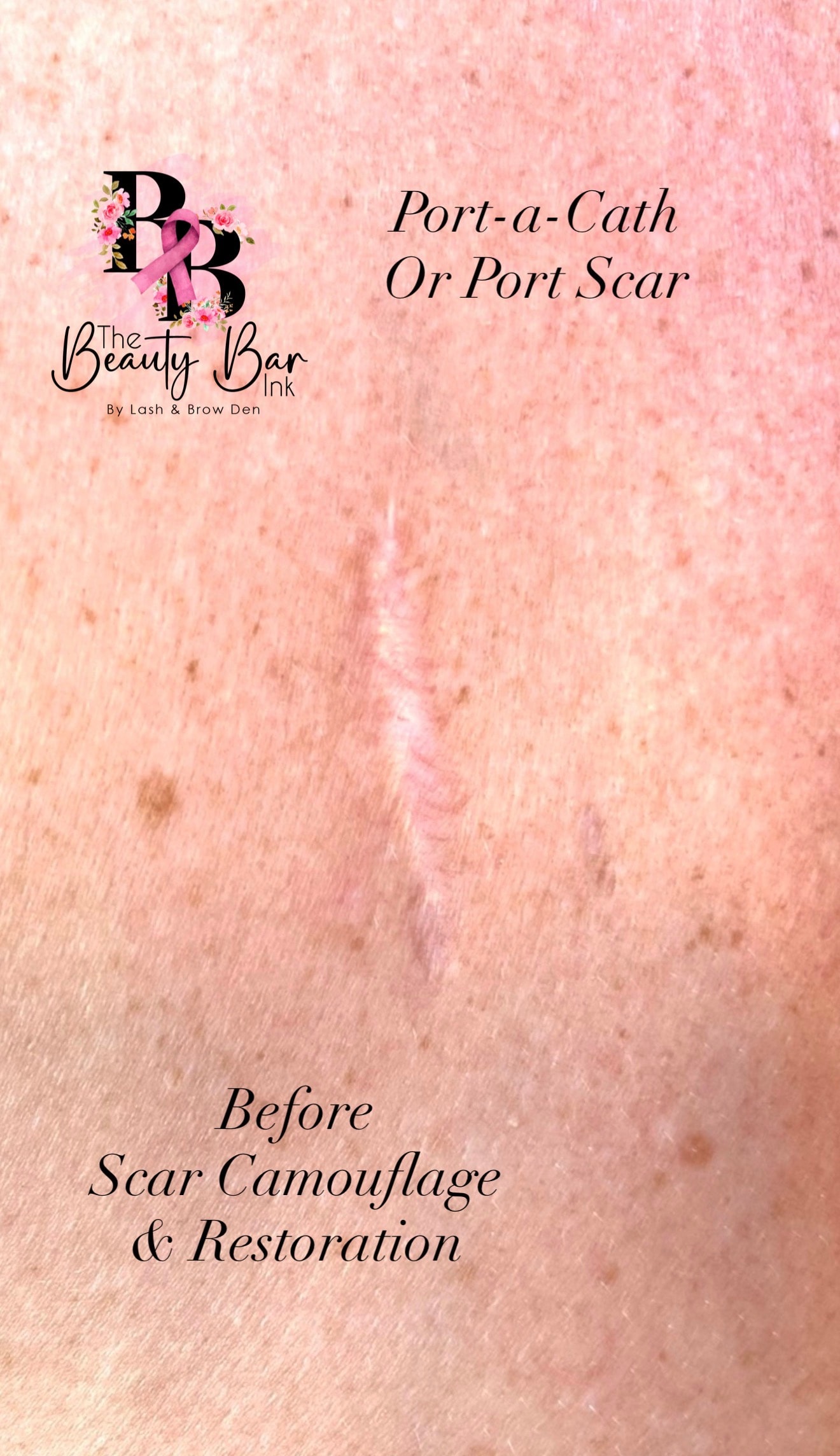 Port-a-Cath or port scar before scar camouflage and restoration treatment