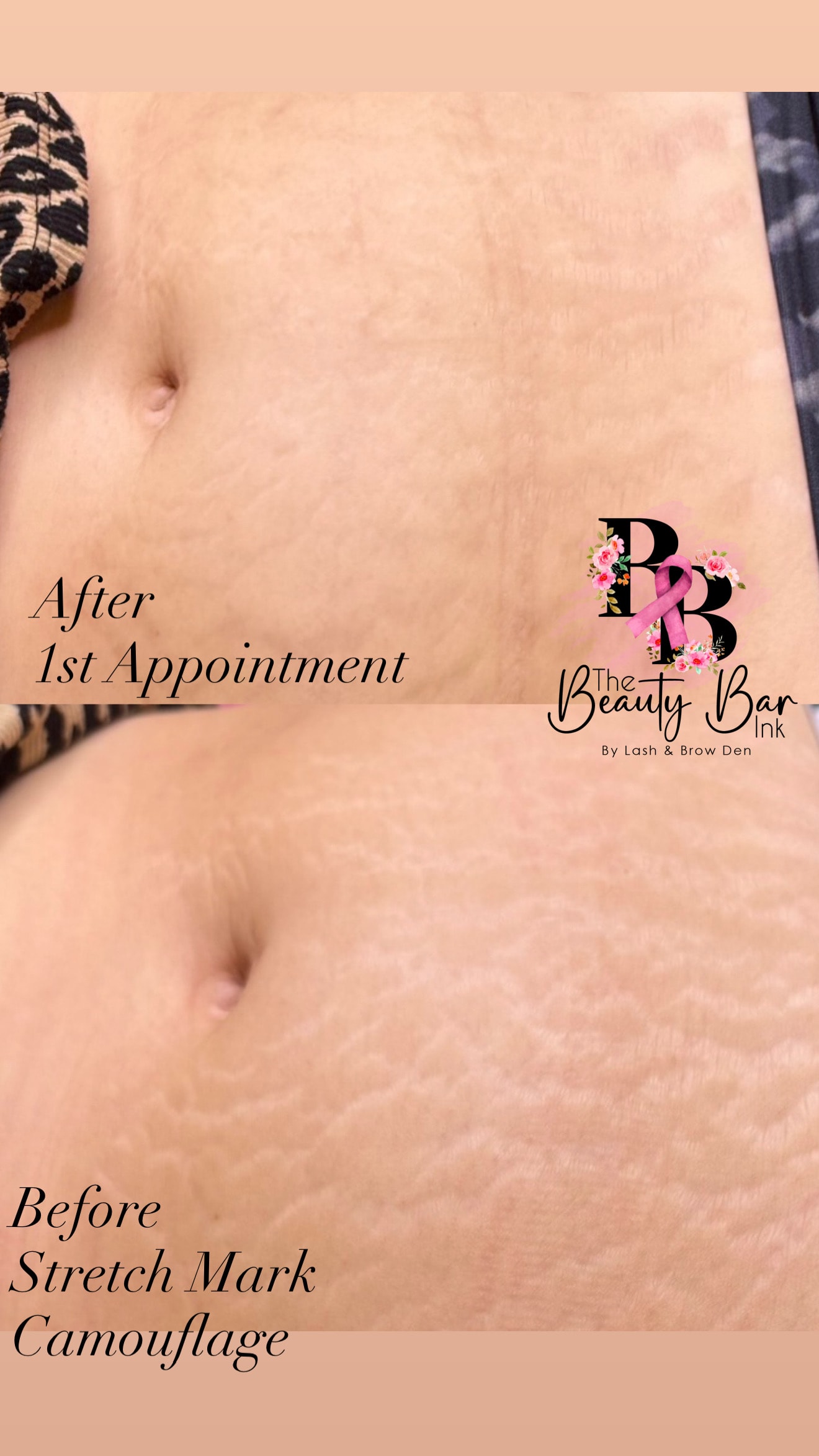 Before and after stretch mark camouflage after first appointment