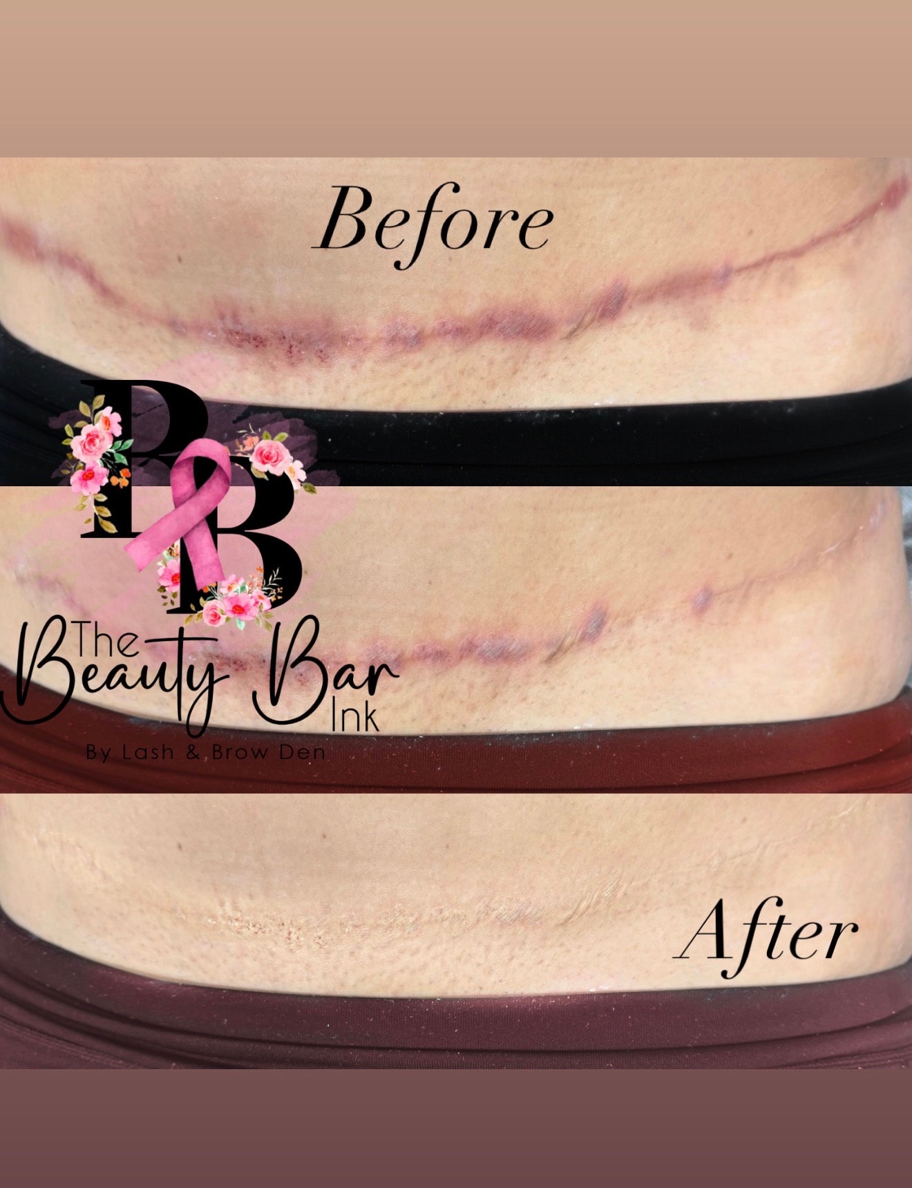 Tummy tuck scar 3 panel before and after scar camouflage and restoration