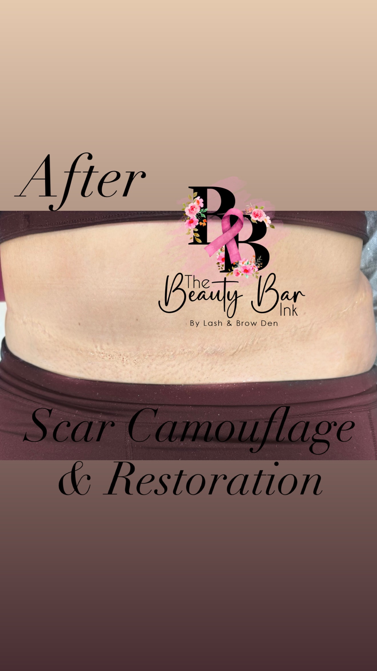 After tummy tuck scar camouflage and restoration branded