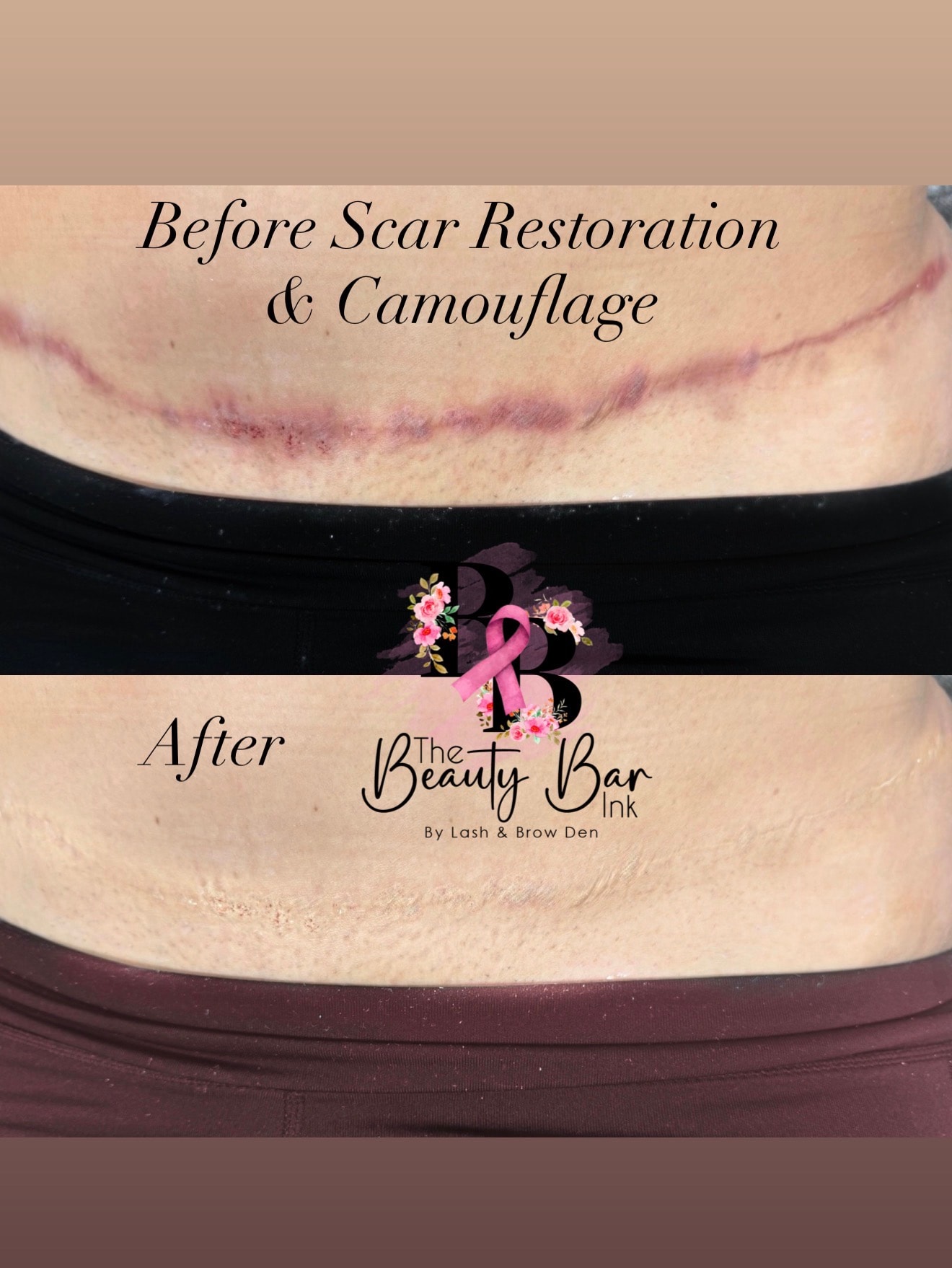 Tummy tuck scar before and after scar restoration and camouflage split view