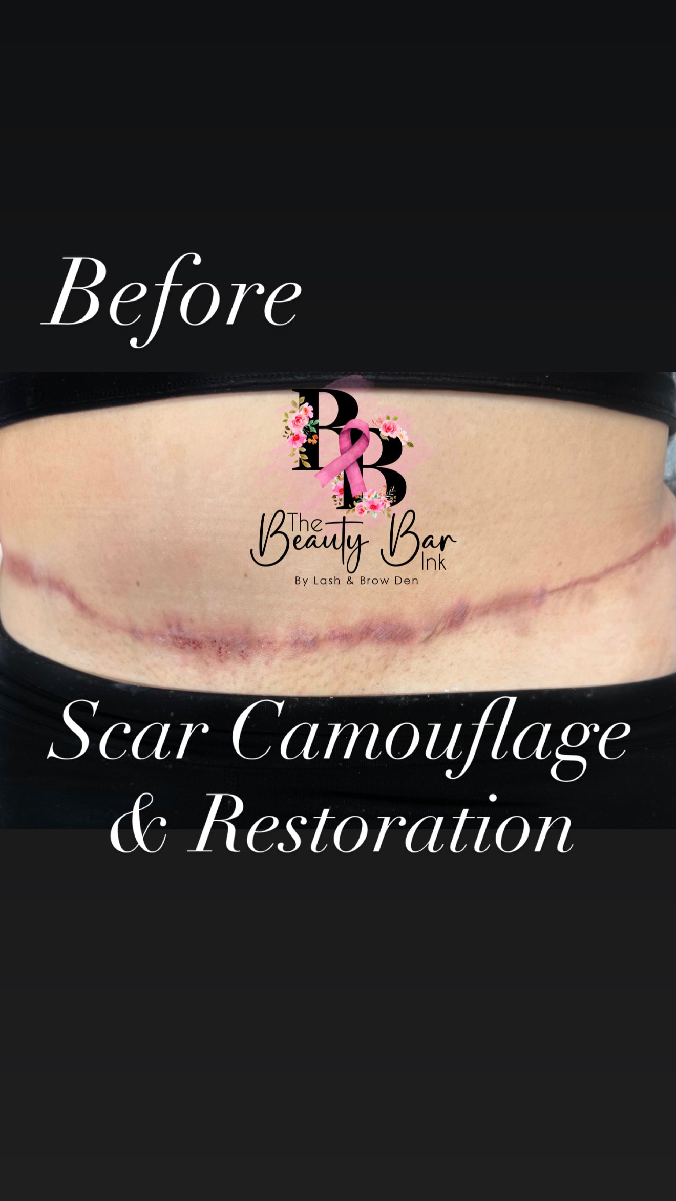 Before tummy tuck scar camouflage and restoration branded