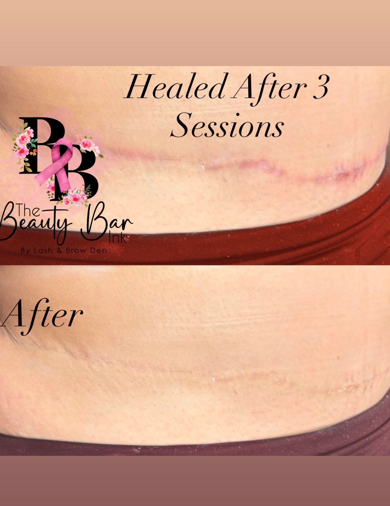 Tummy tuck scar healed after 3 sessions scar camouflage and restoration
