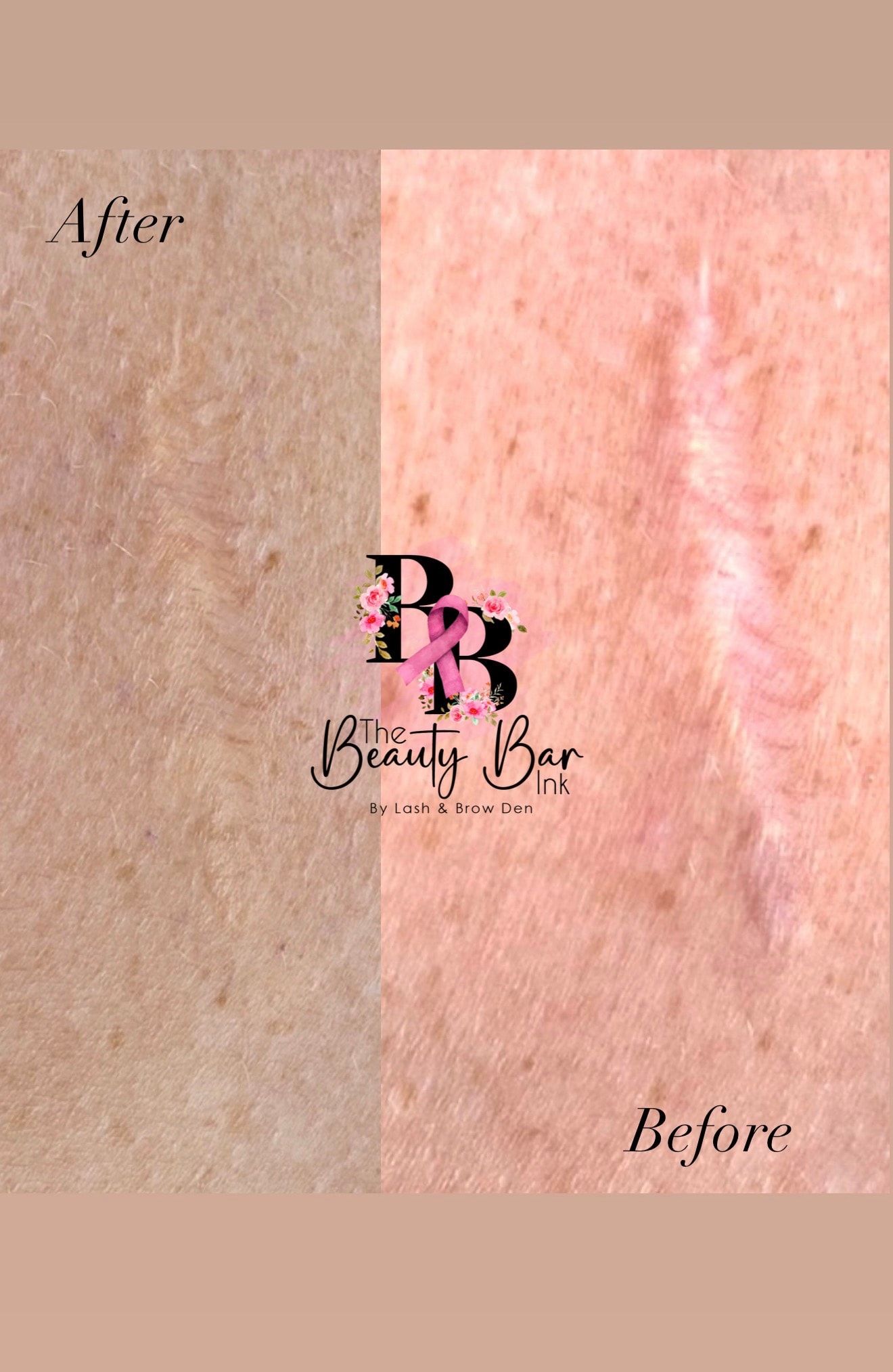 Tummy tuck scar 4 panel progress showing scar camouflage and restoration treatment stages