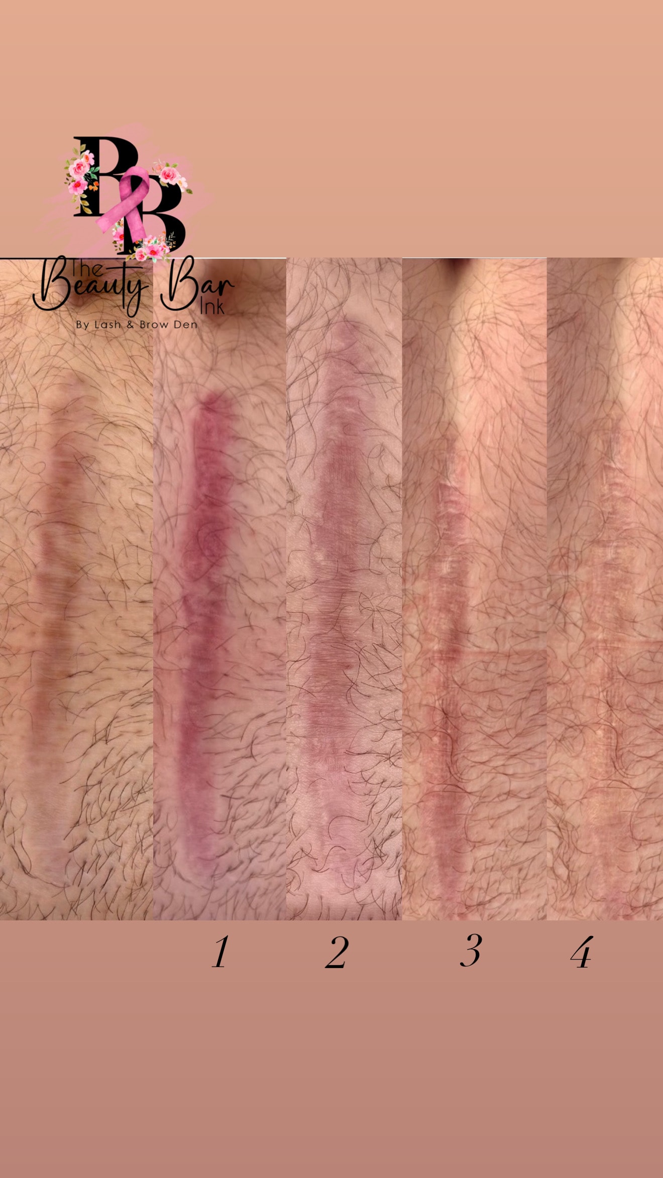 Tummy tuck scar healed after scar camouflage and restoration treatment